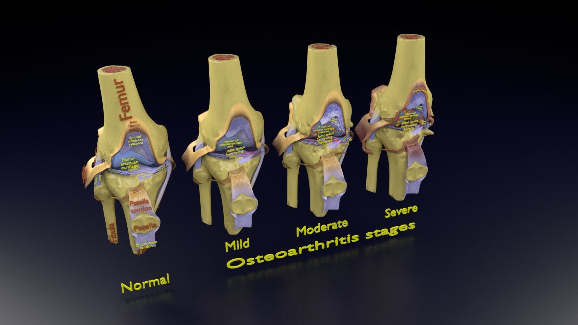 Osteoarthritis stages 3D model_108