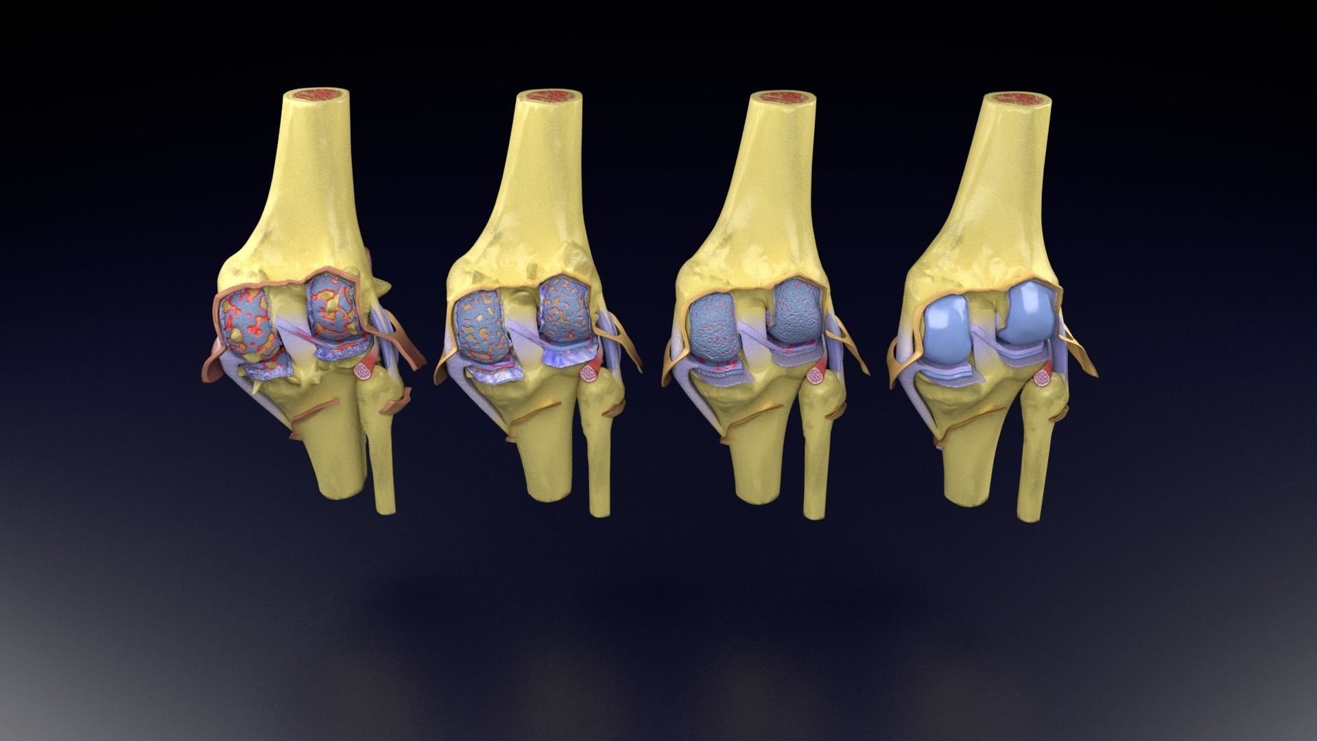 Osteoarthritis stages 3D model_87