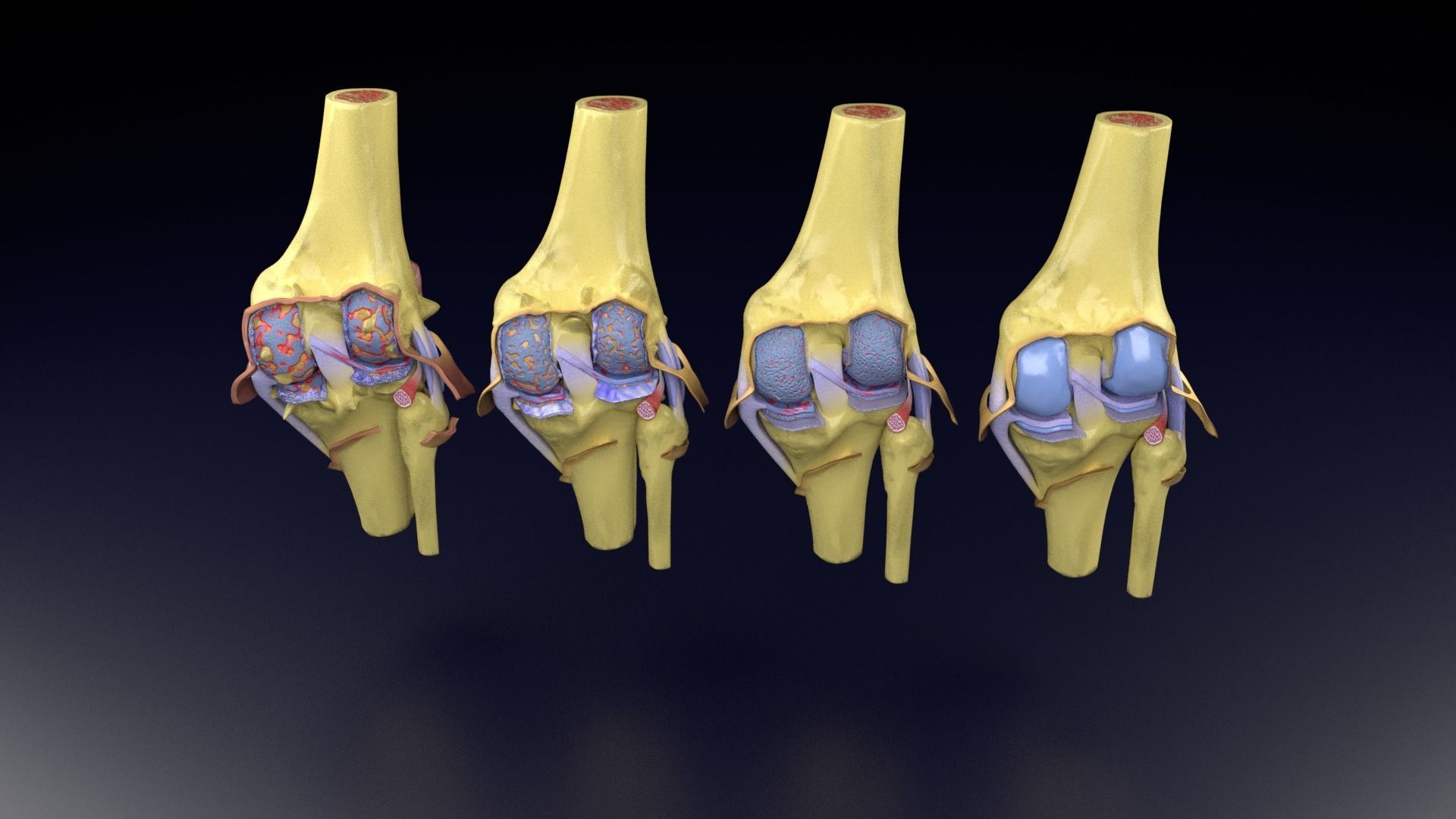 Osteoarthritis stages 3D model_85