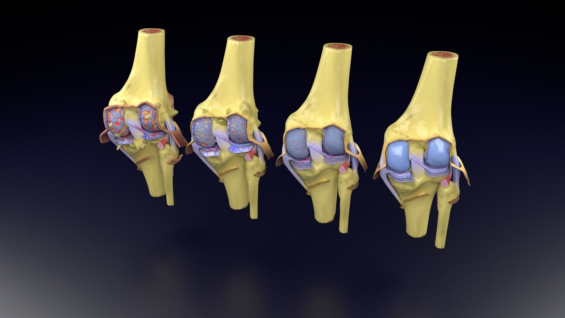 Osteoarthritis stages 3D model_63