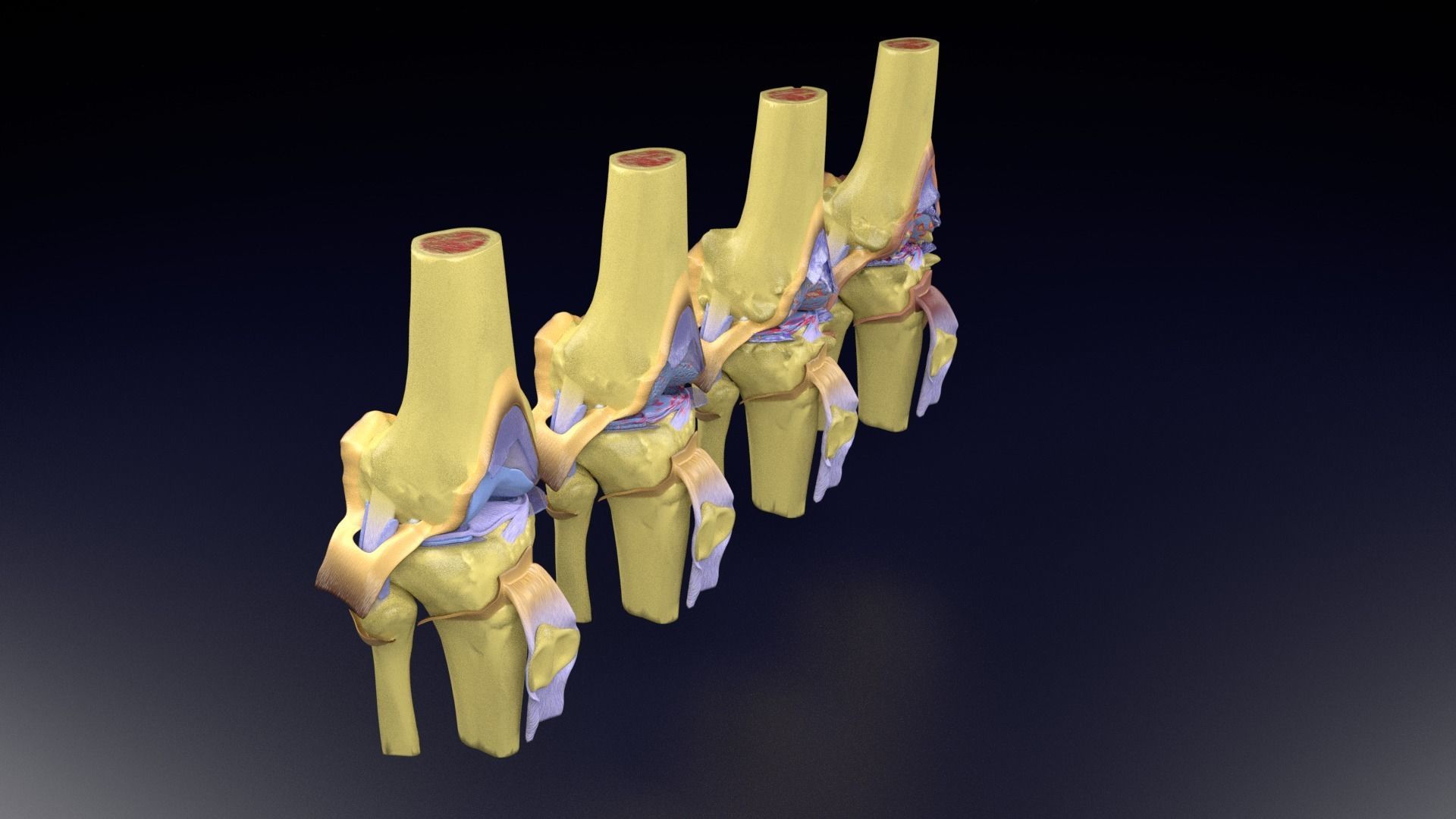 Osteoarthritis stages 3D model_102