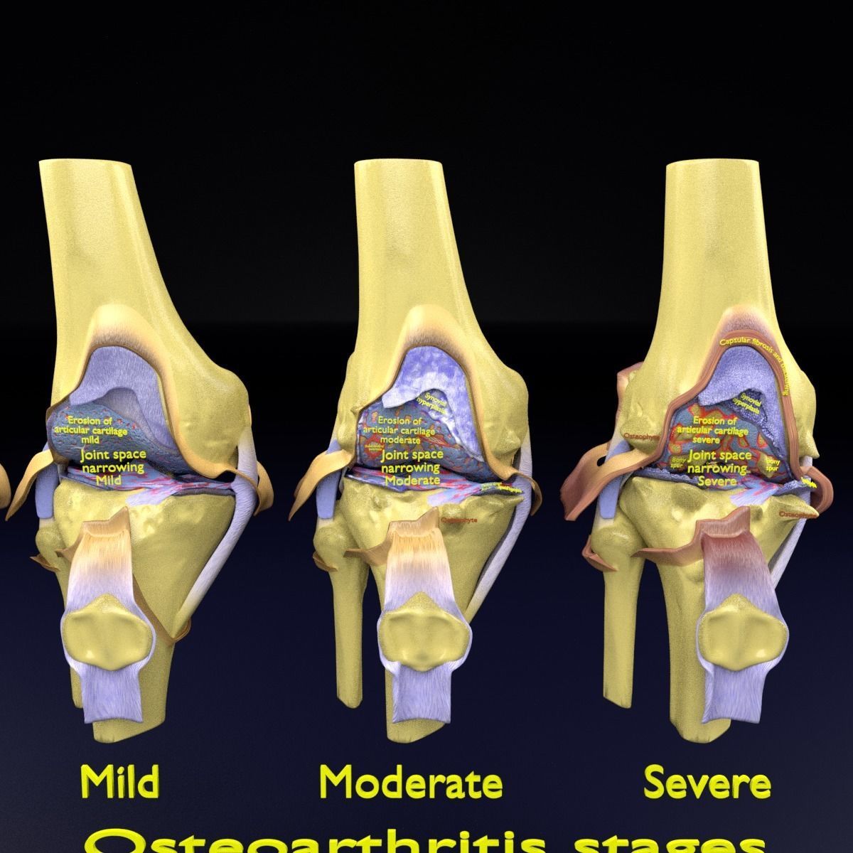 Osteoarthritis stages 3D model_24