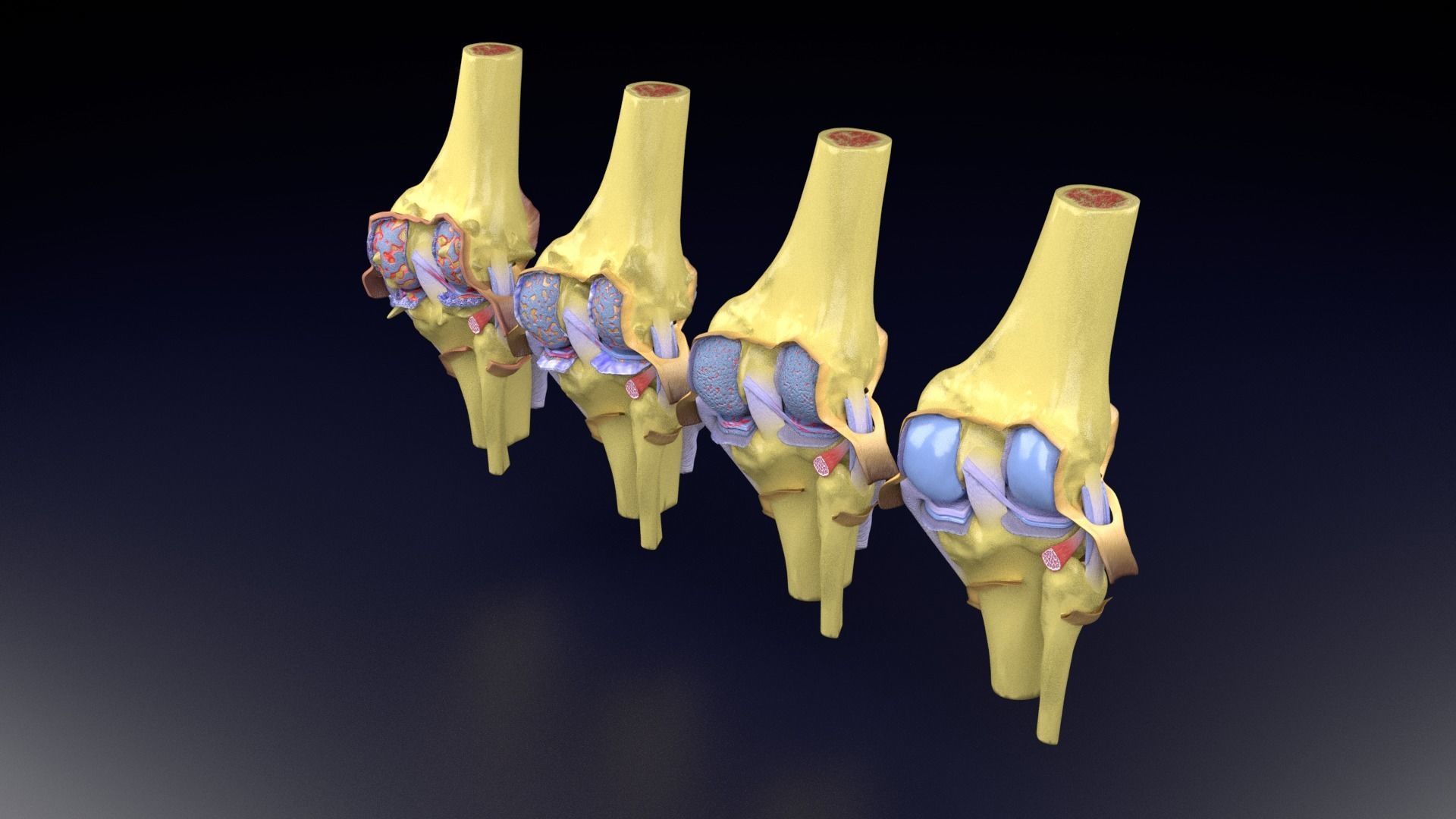 Osteoarthritis stages 3D model_54