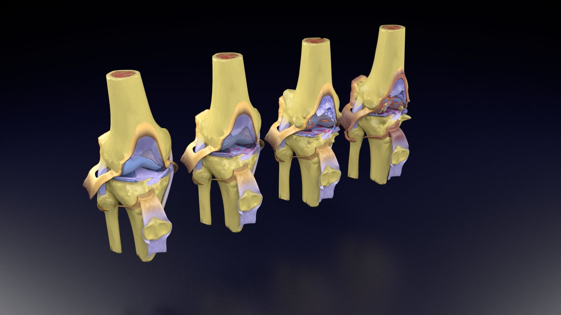 Osteoarthritis stages 3D model_100