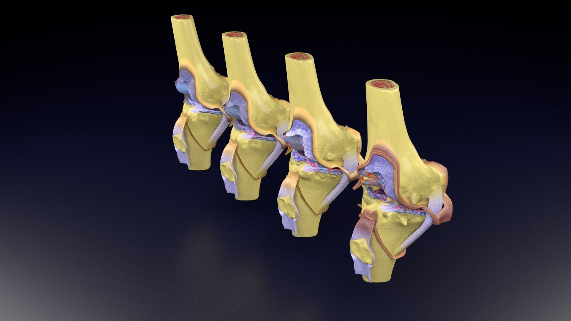 Osteoarthritis stages 3D model_80