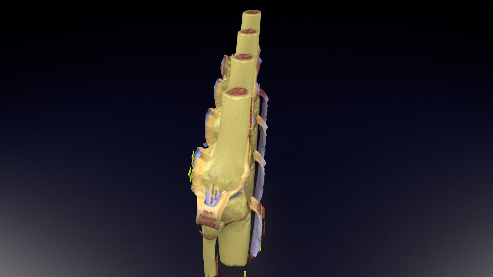 Osteoarthritis stages 3D model_135