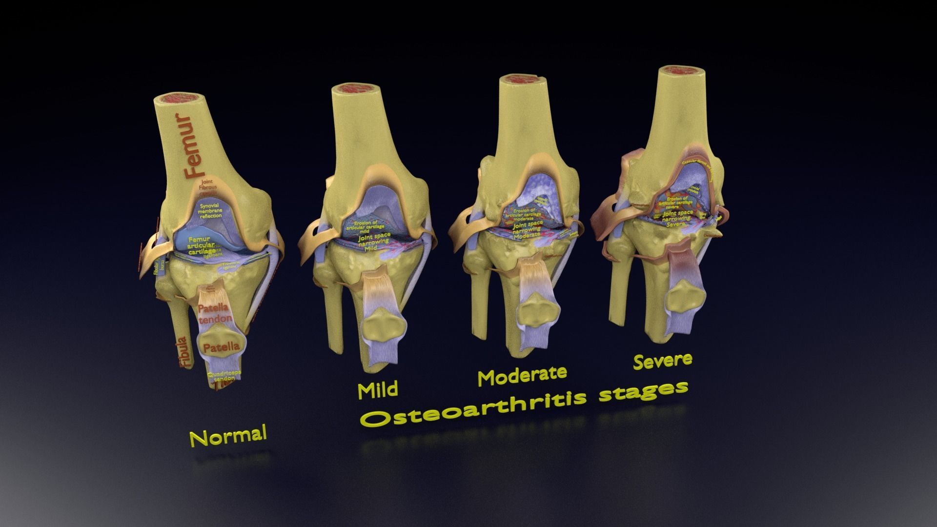 Osteoarthritis stages 3D model_111