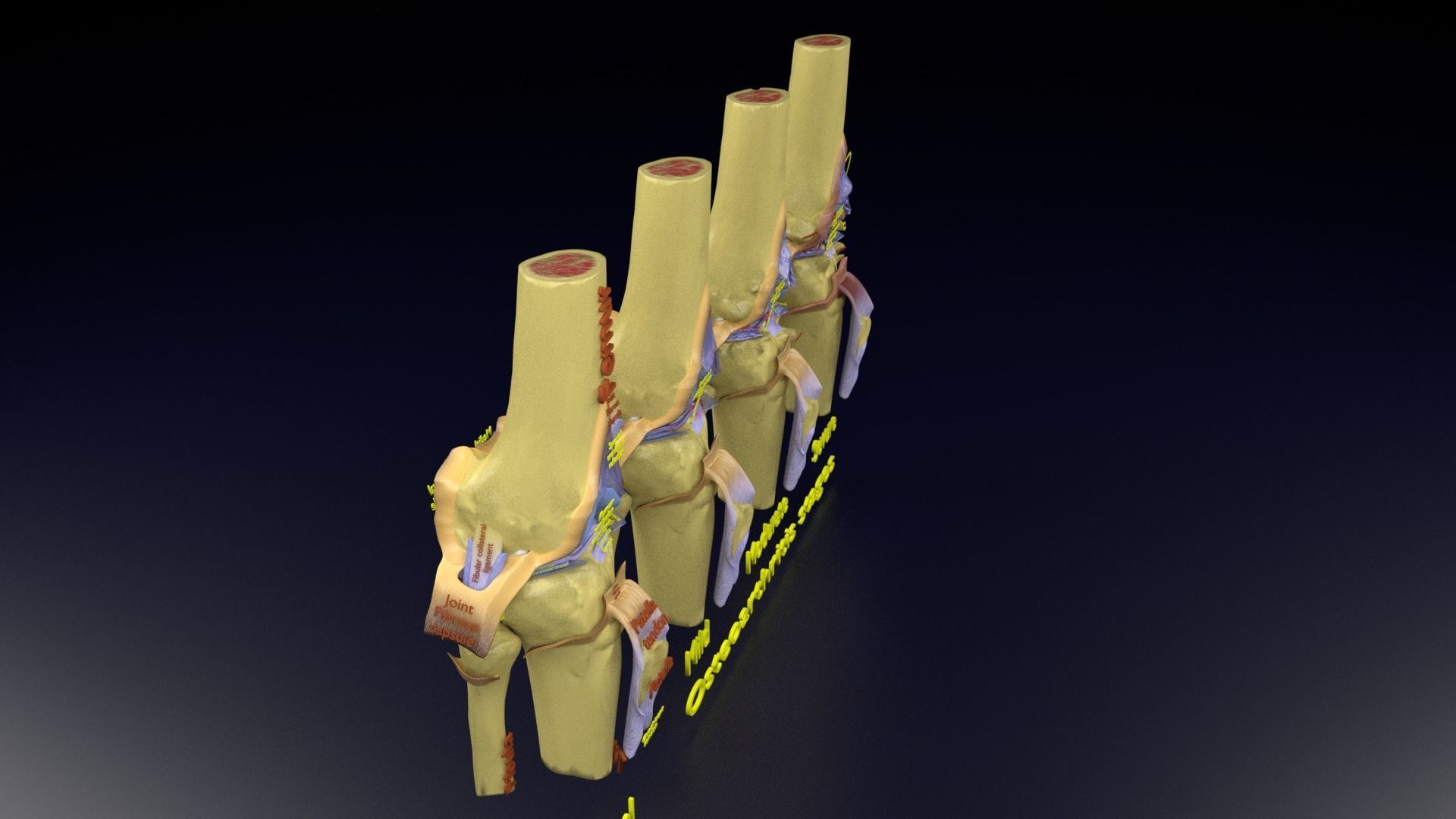 Osteoarthritis stages 3D model_119