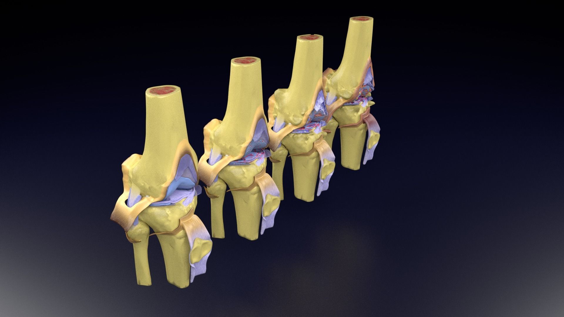 Osteoarthritis stages 3D model_107