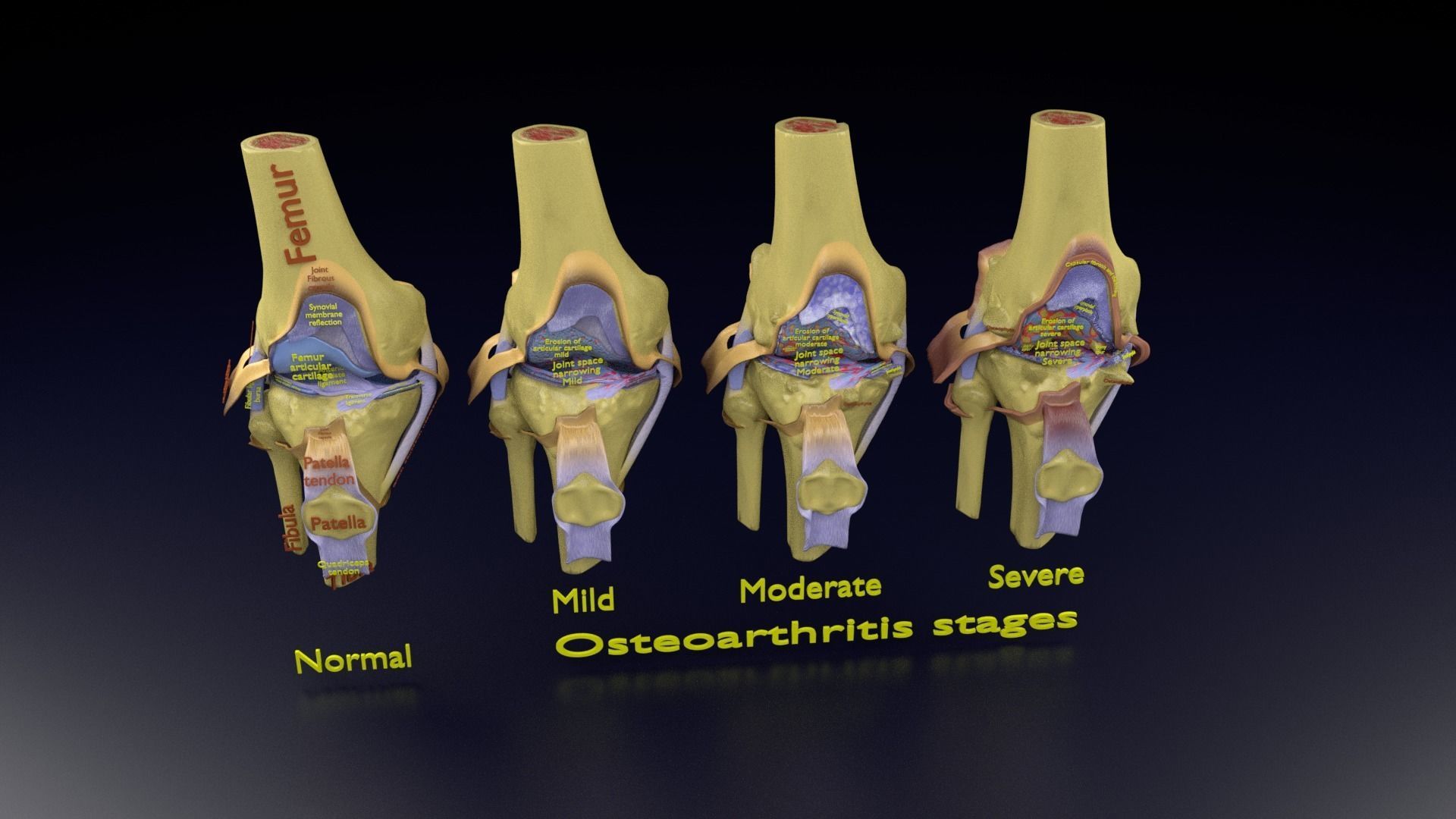 Osteoarthritis stages 3D model_109