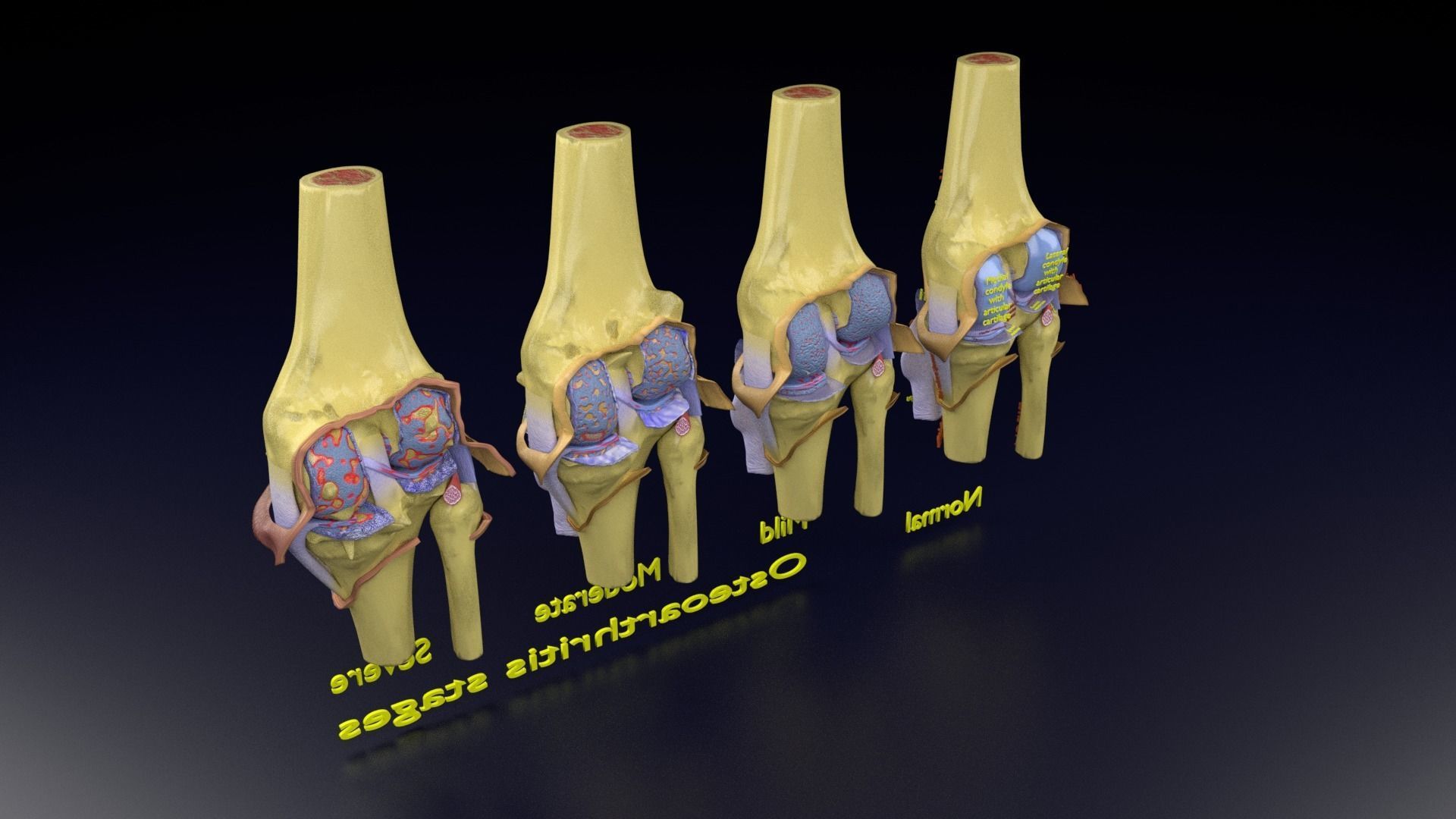Osteoarthritis stages 3D model_150