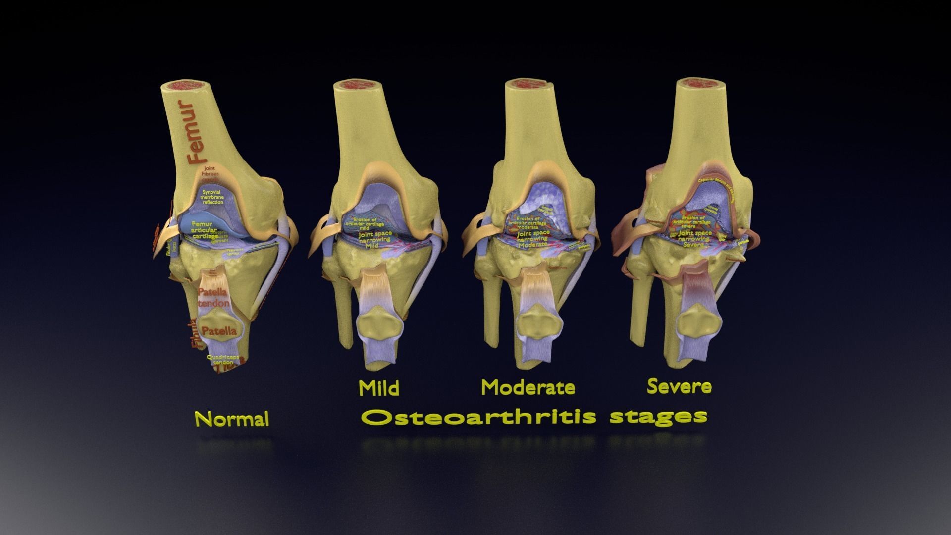 Osteoarthritis stages 3D model_110