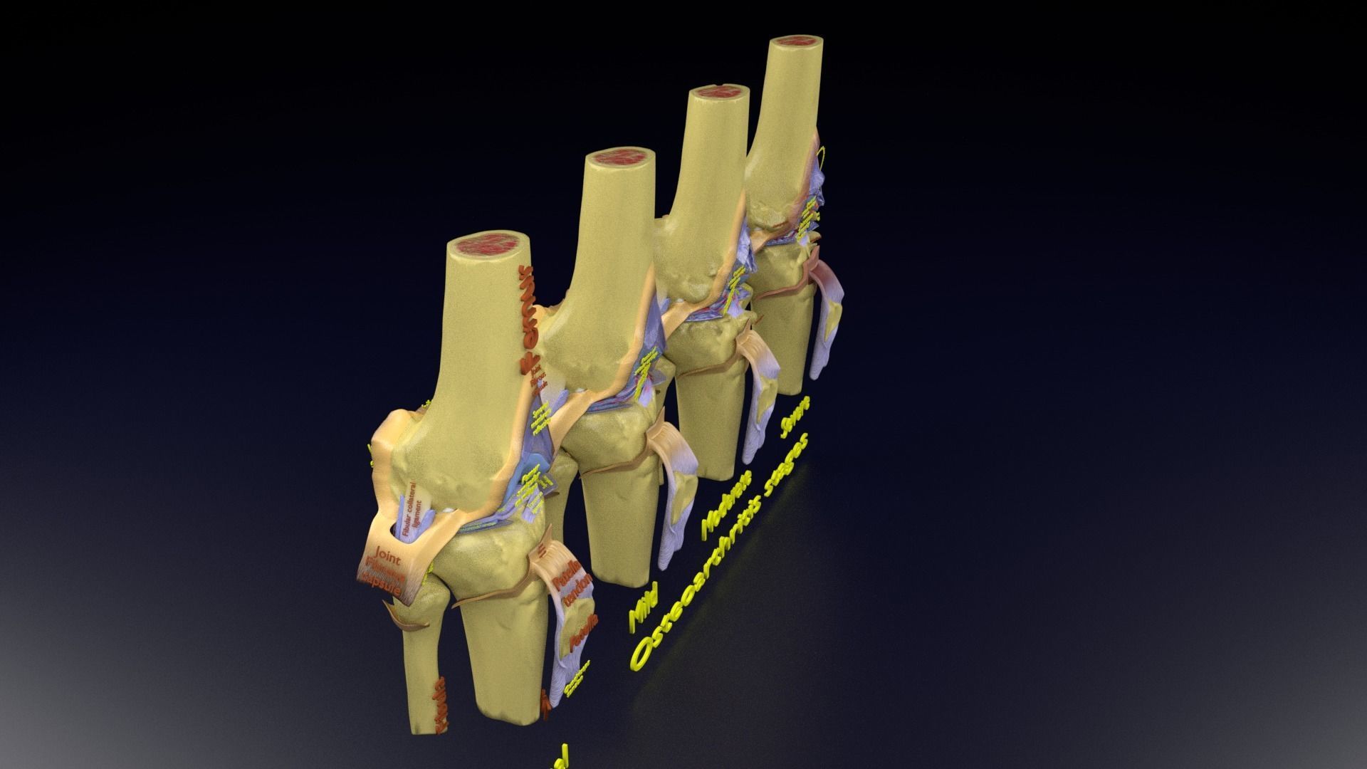 Osteoarthritis stages 3D model_121