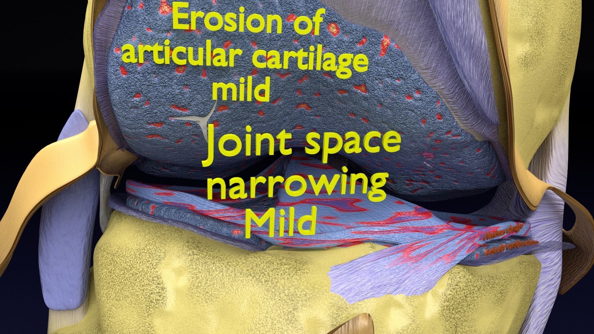 Osteoarthritis stages 3D model_27
