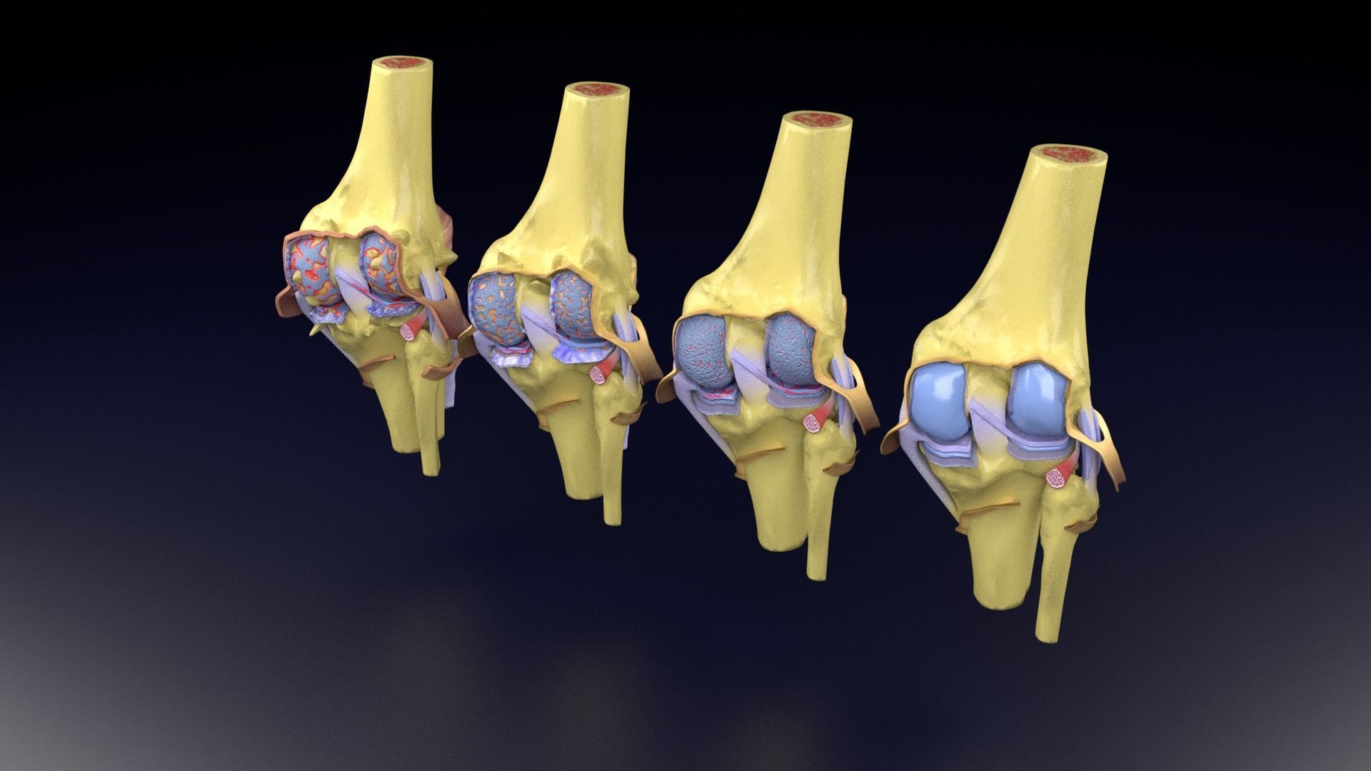 Osteoarthritis stages 3D model_53