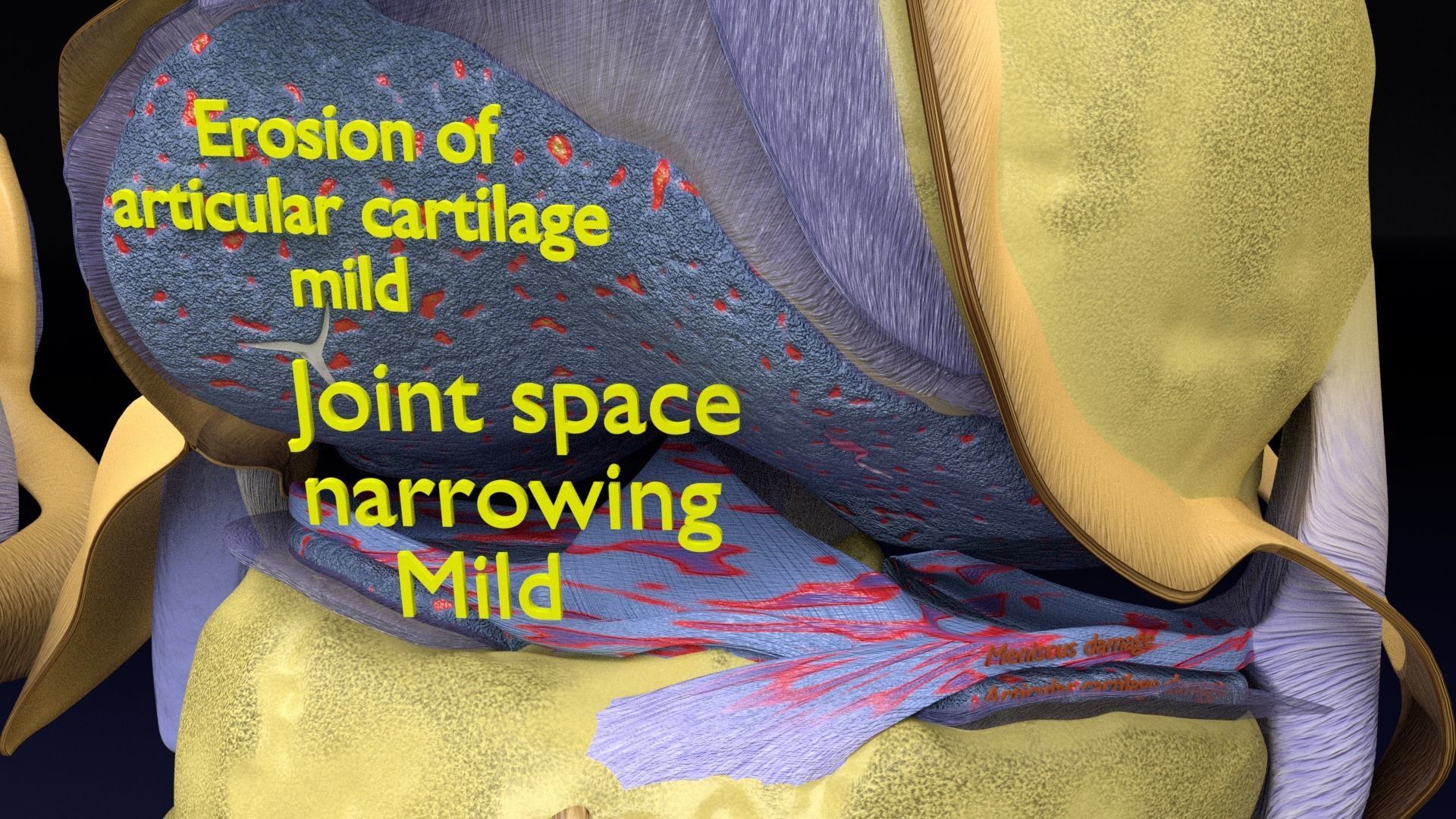 Osteoarthritis stages 3D model_28