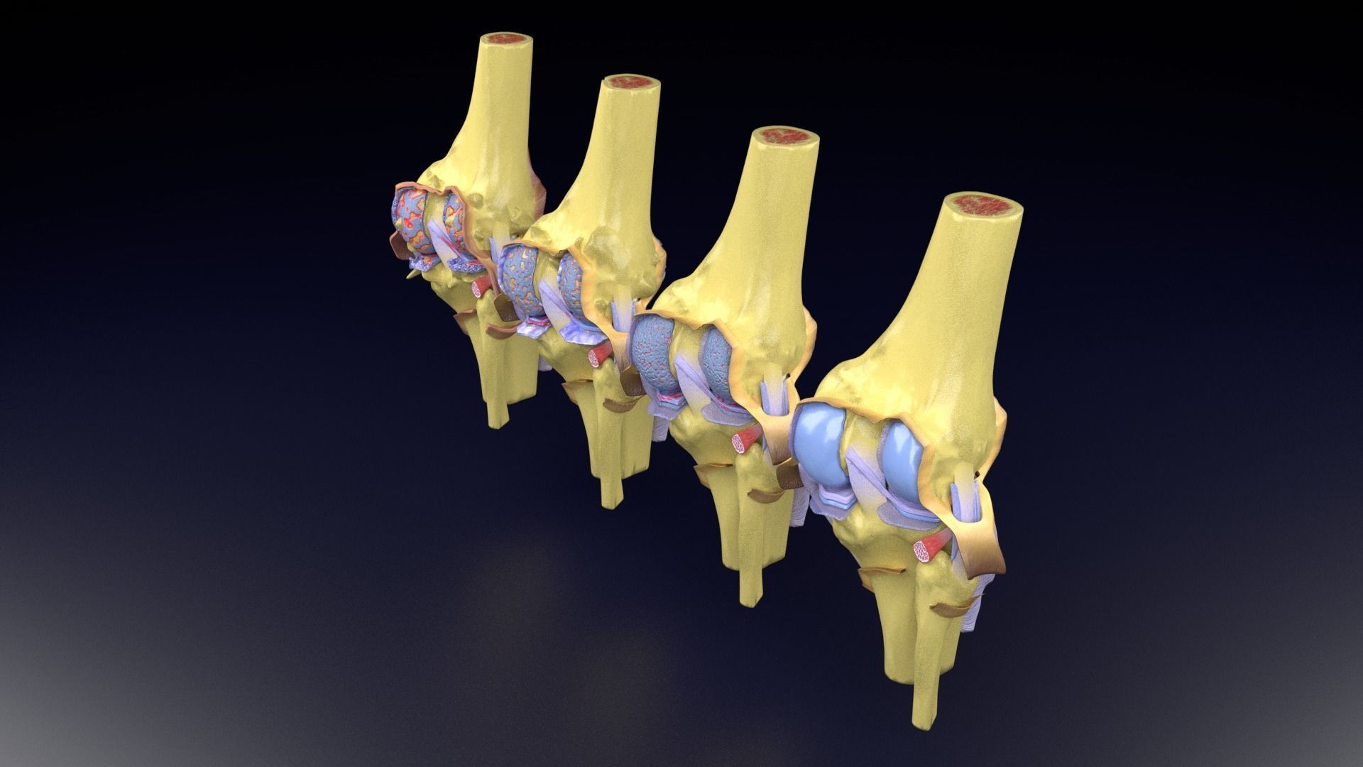 Osteoarthritis stages 3D model_48