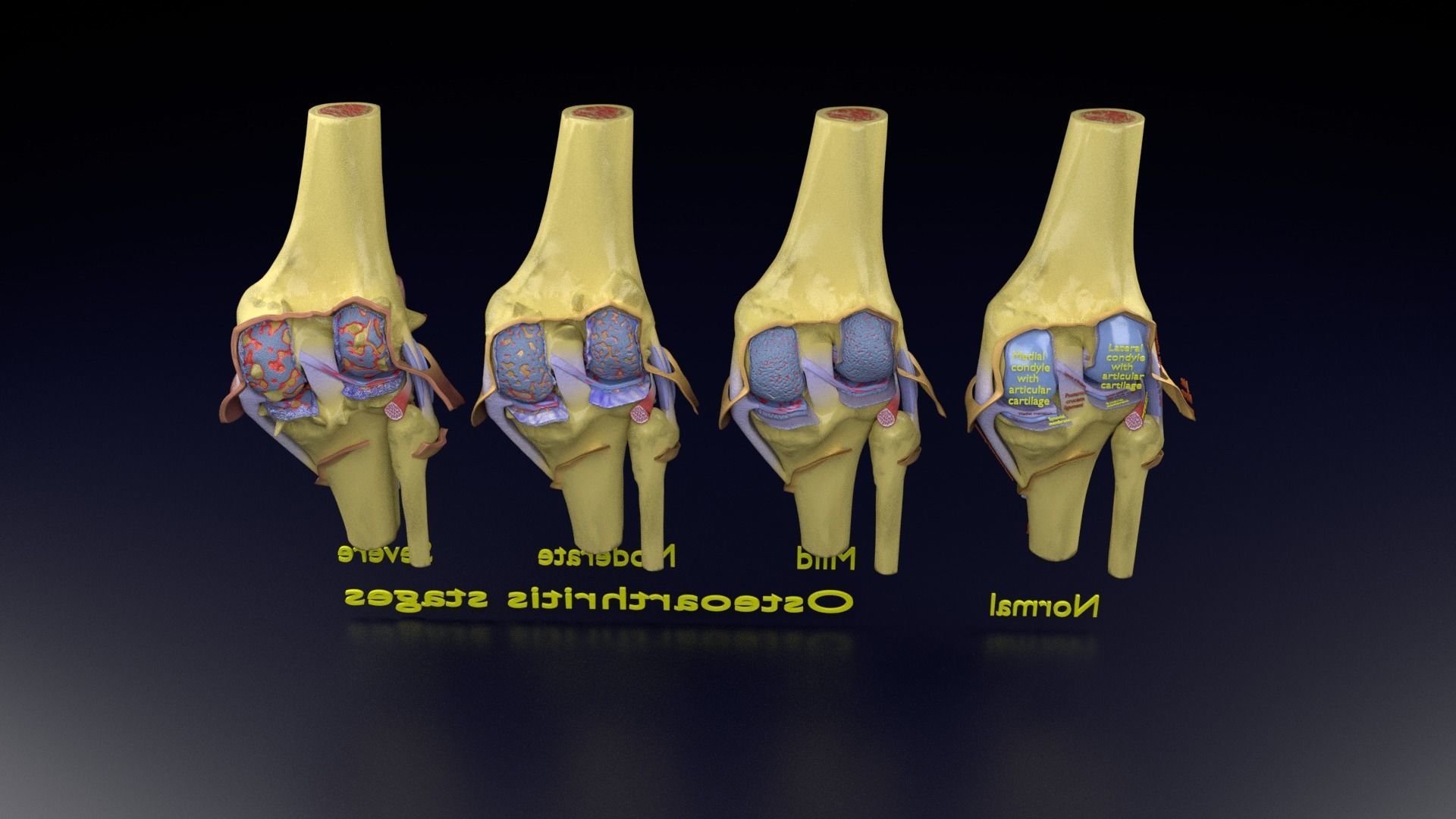 Osteoarthritis stages 3D model_141