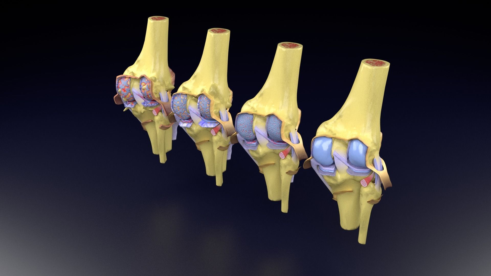 Osteoarthritis stages 3D model_51