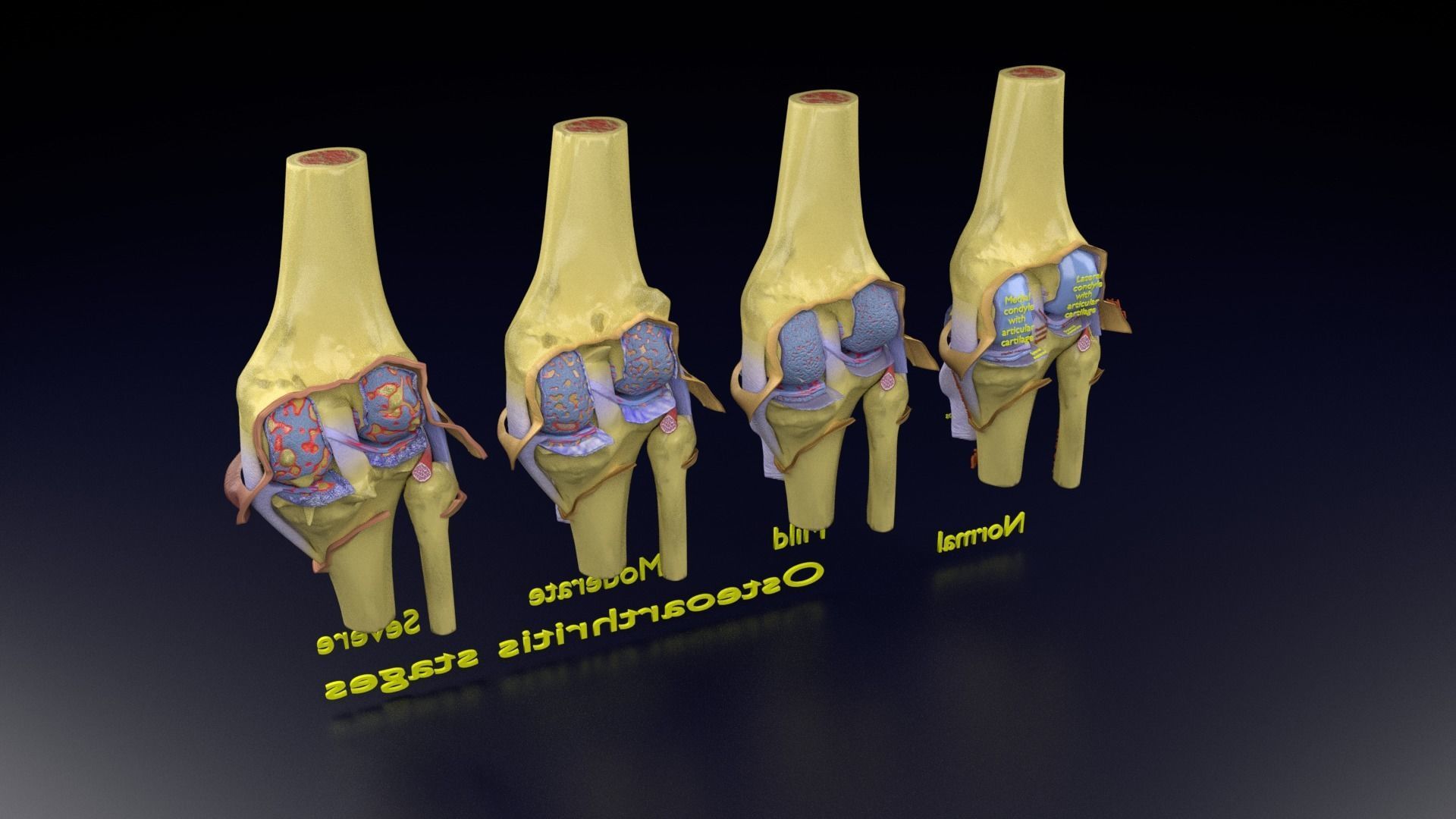 Osteoarthritis stages 3D model_149