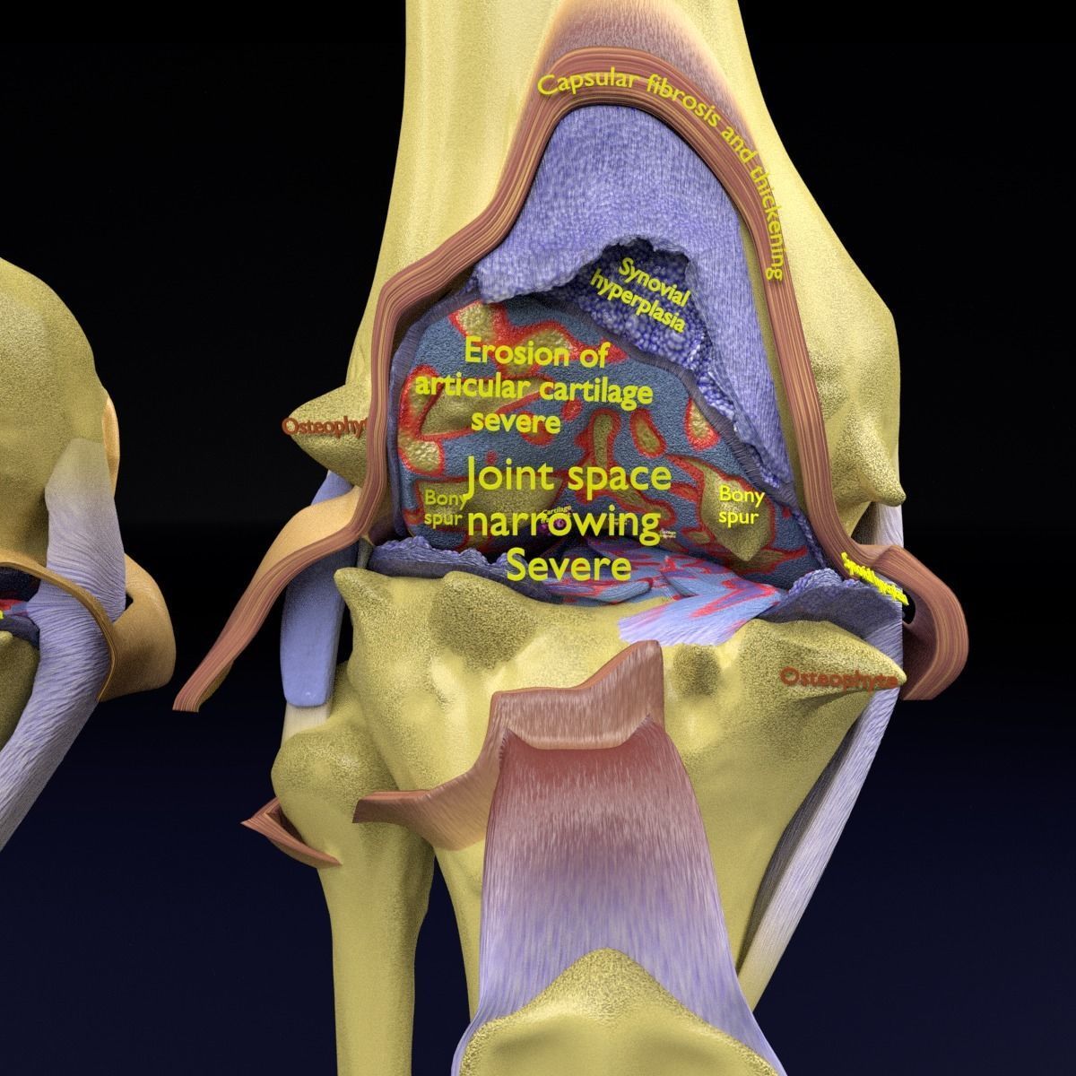 Osteoarthritis stages 3D model_12