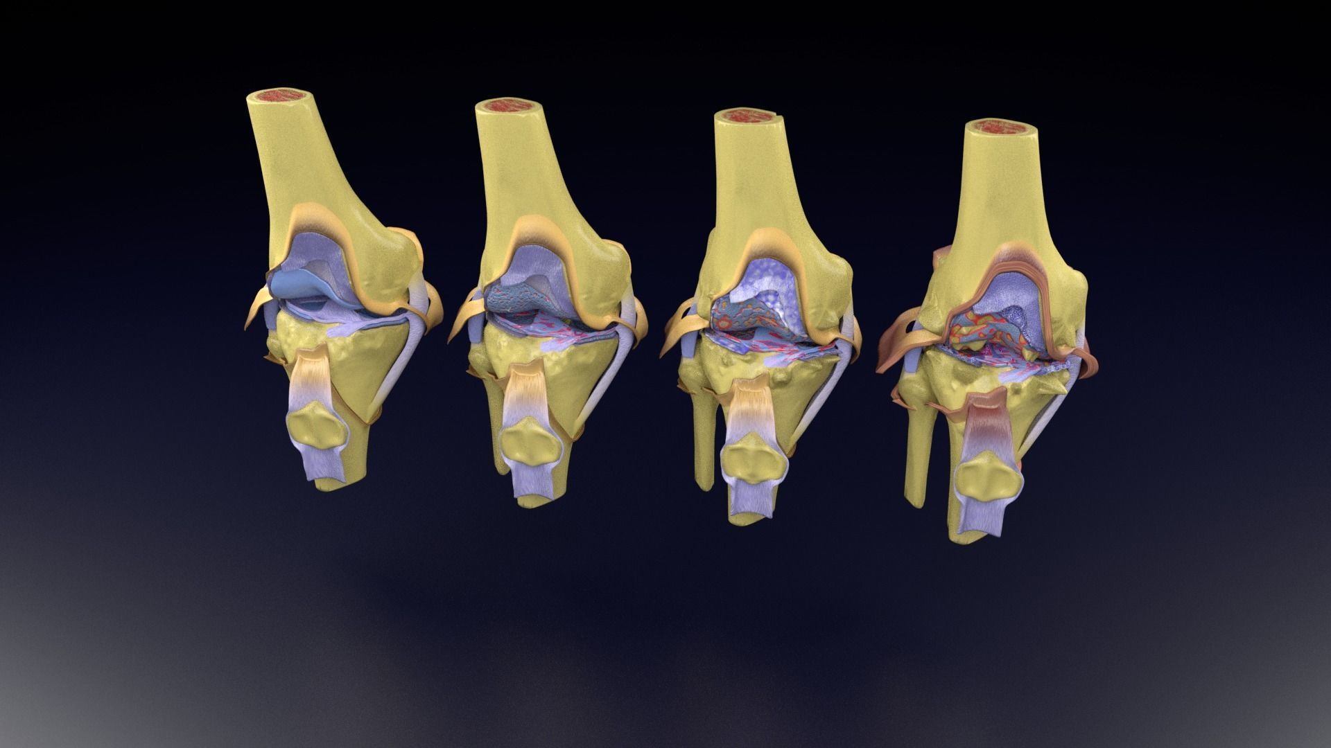 Osteoarthritis stages 3D model_93