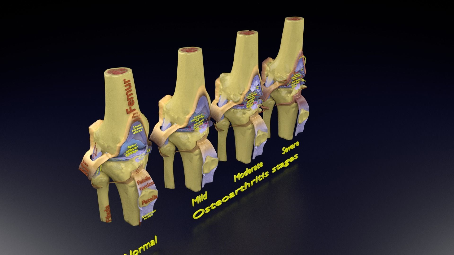 Osteoarthritis stages 3D model_142