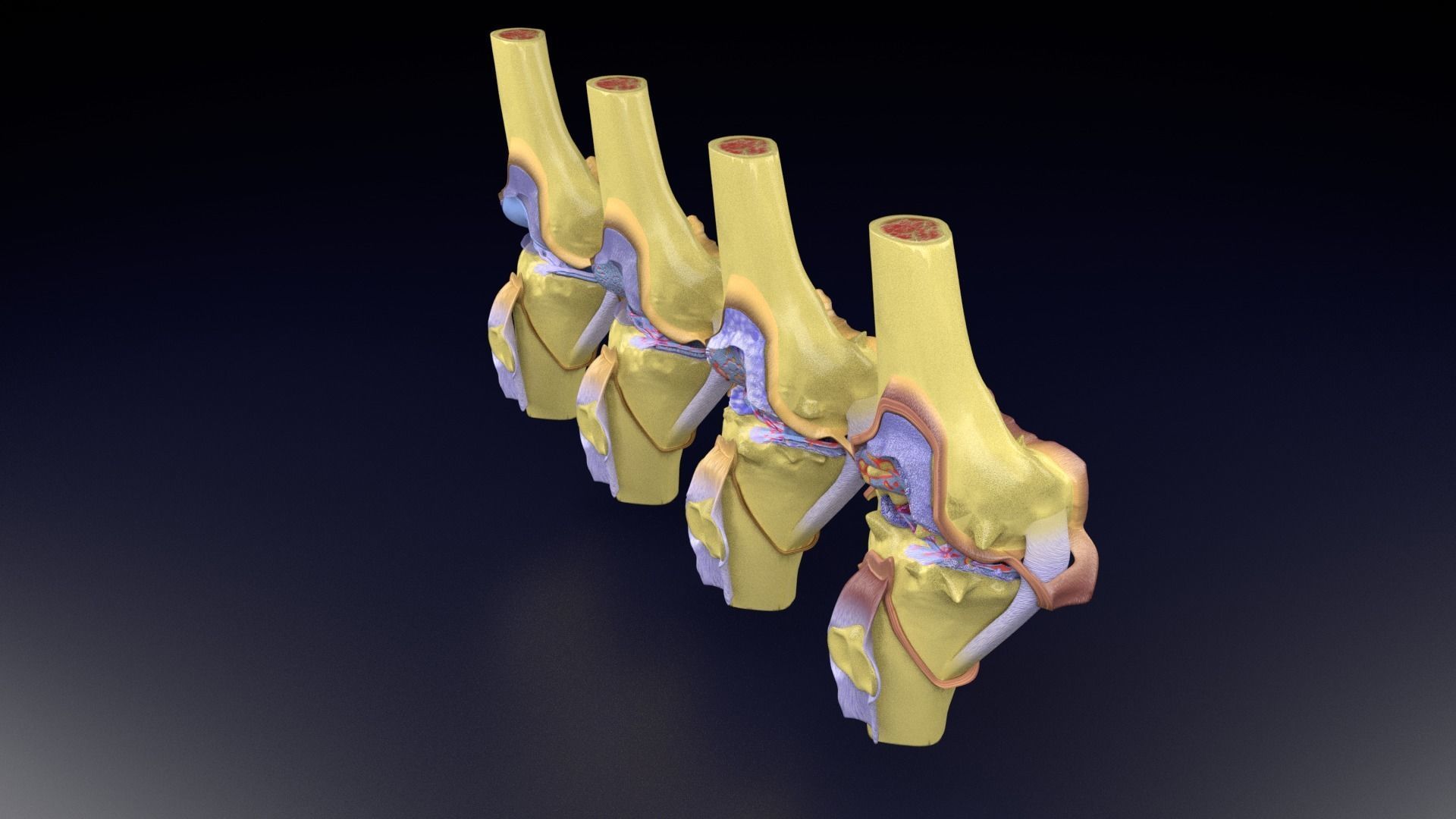 Osteoarthritis stages 3D model_79
