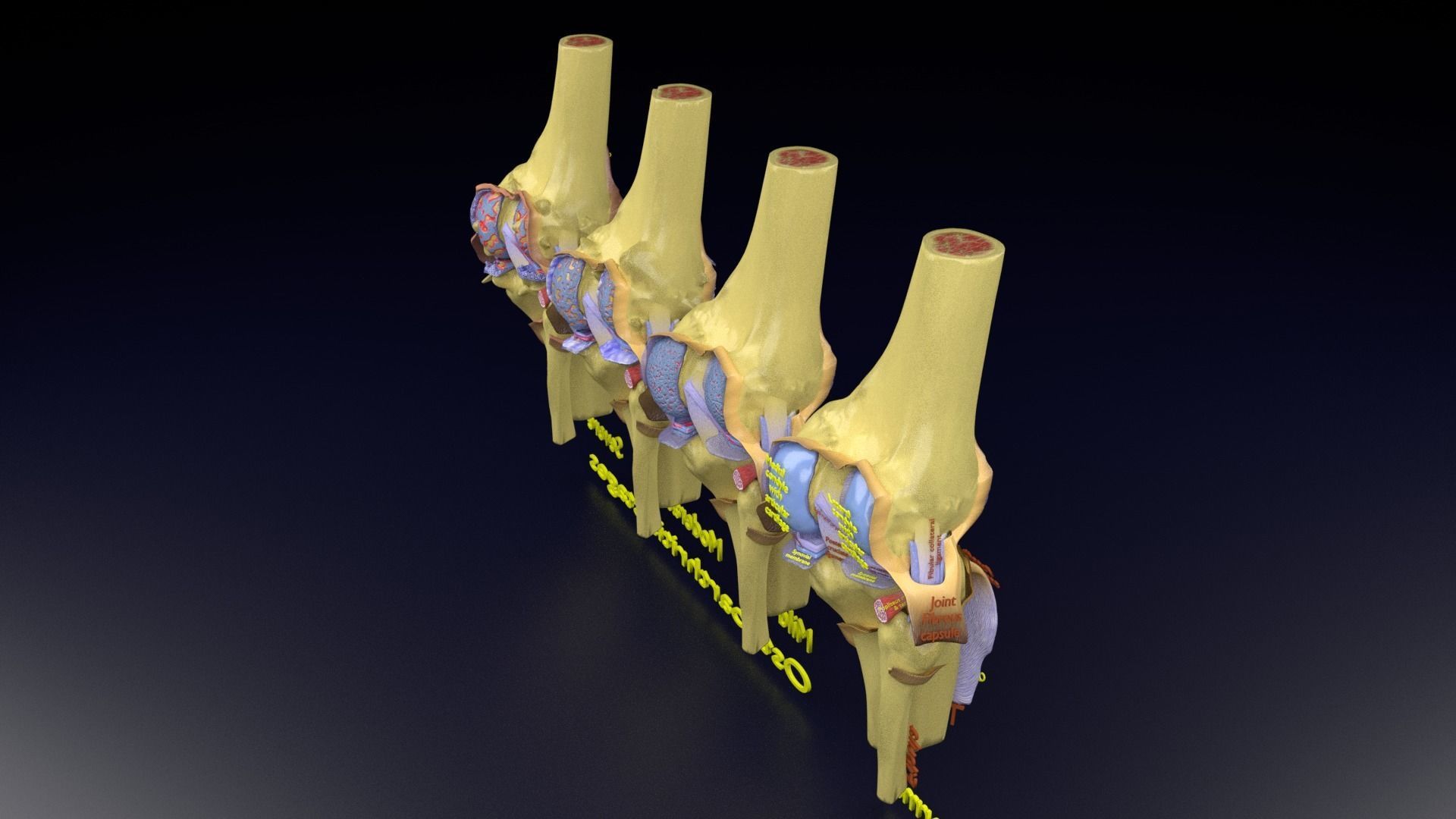 Osteoarthritis stages 3D model_128