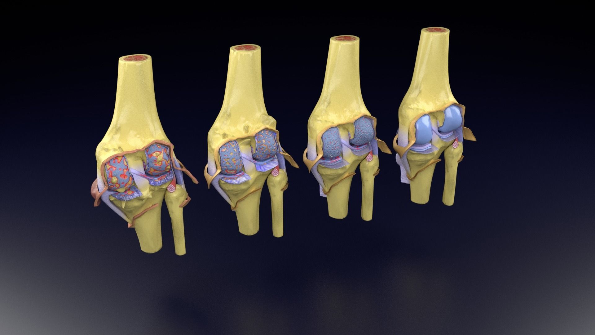 Osteoarthritis stages 3D model_86