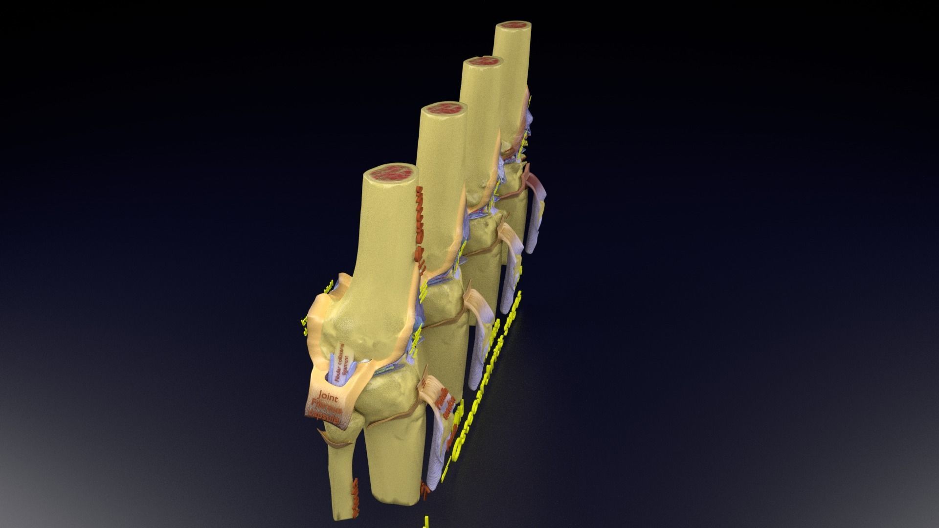 Osteoarthritis stages 3D model_123