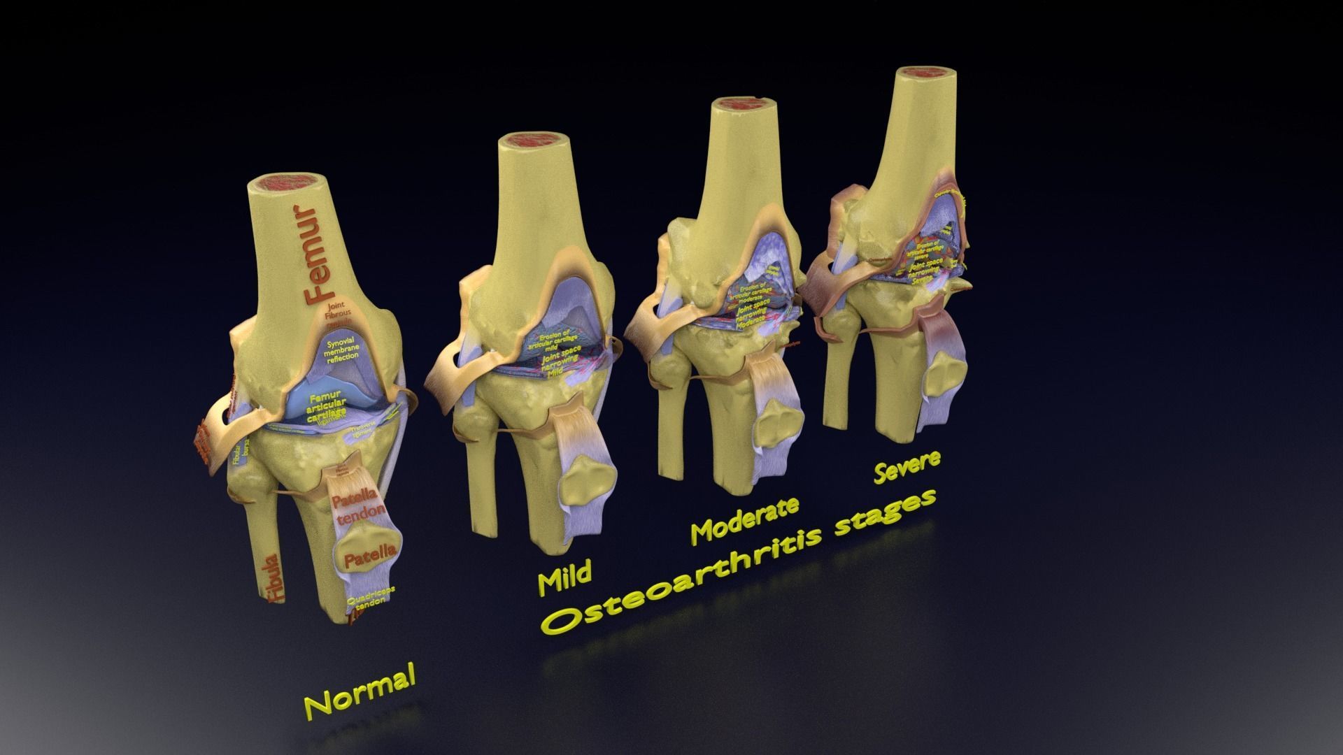 Osteoarthritis stages 3D model_114
