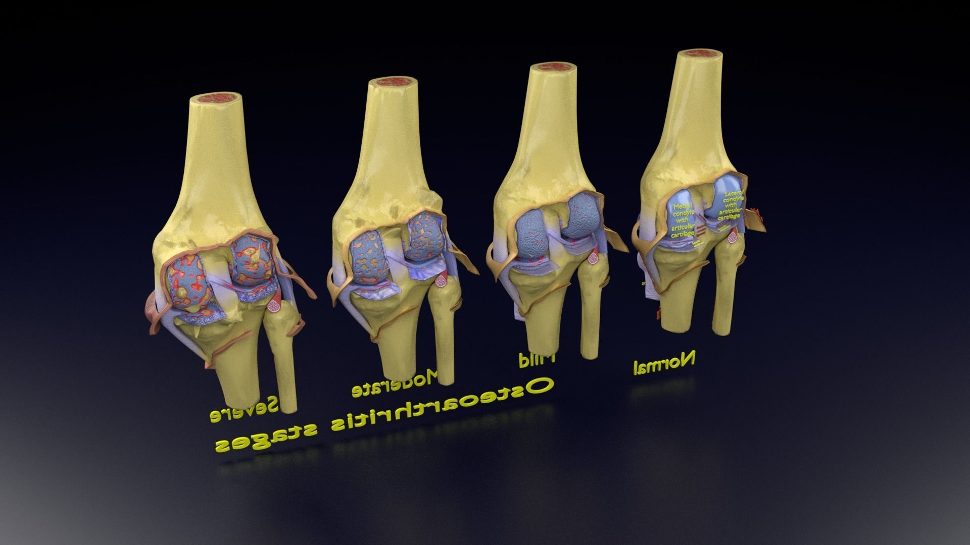Osteoarthritis stages 3D model_144