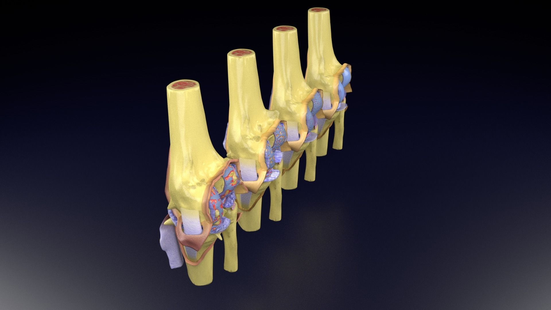 Osteoarthritis stages 3D model_68