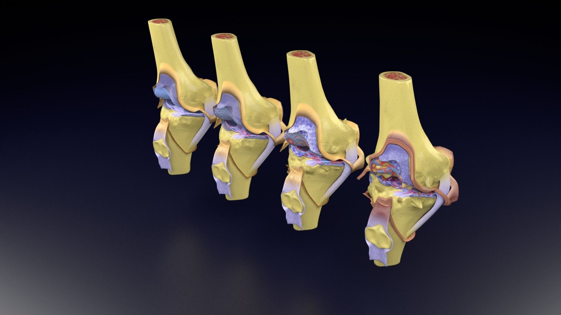 Osteoarthritis stages 3D model_82