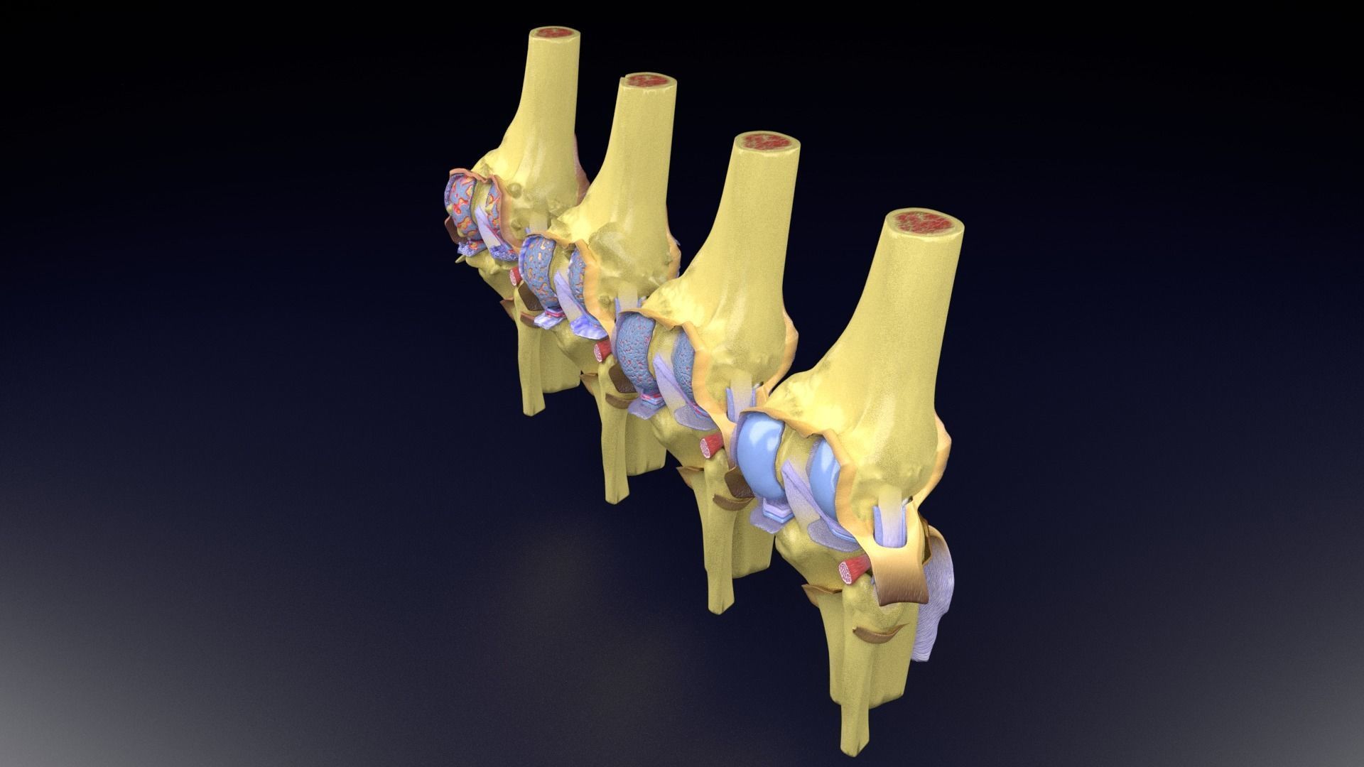 Osteoarthritis stages 3D model_57