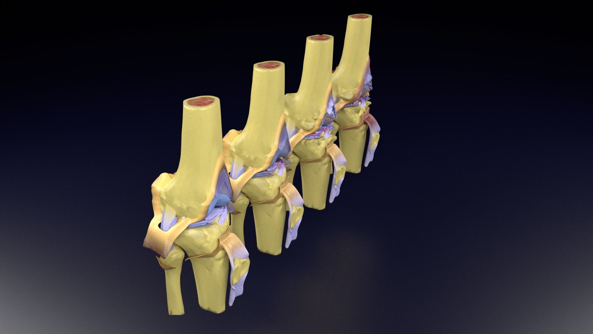 Osteoarthritis stages 3D model_36