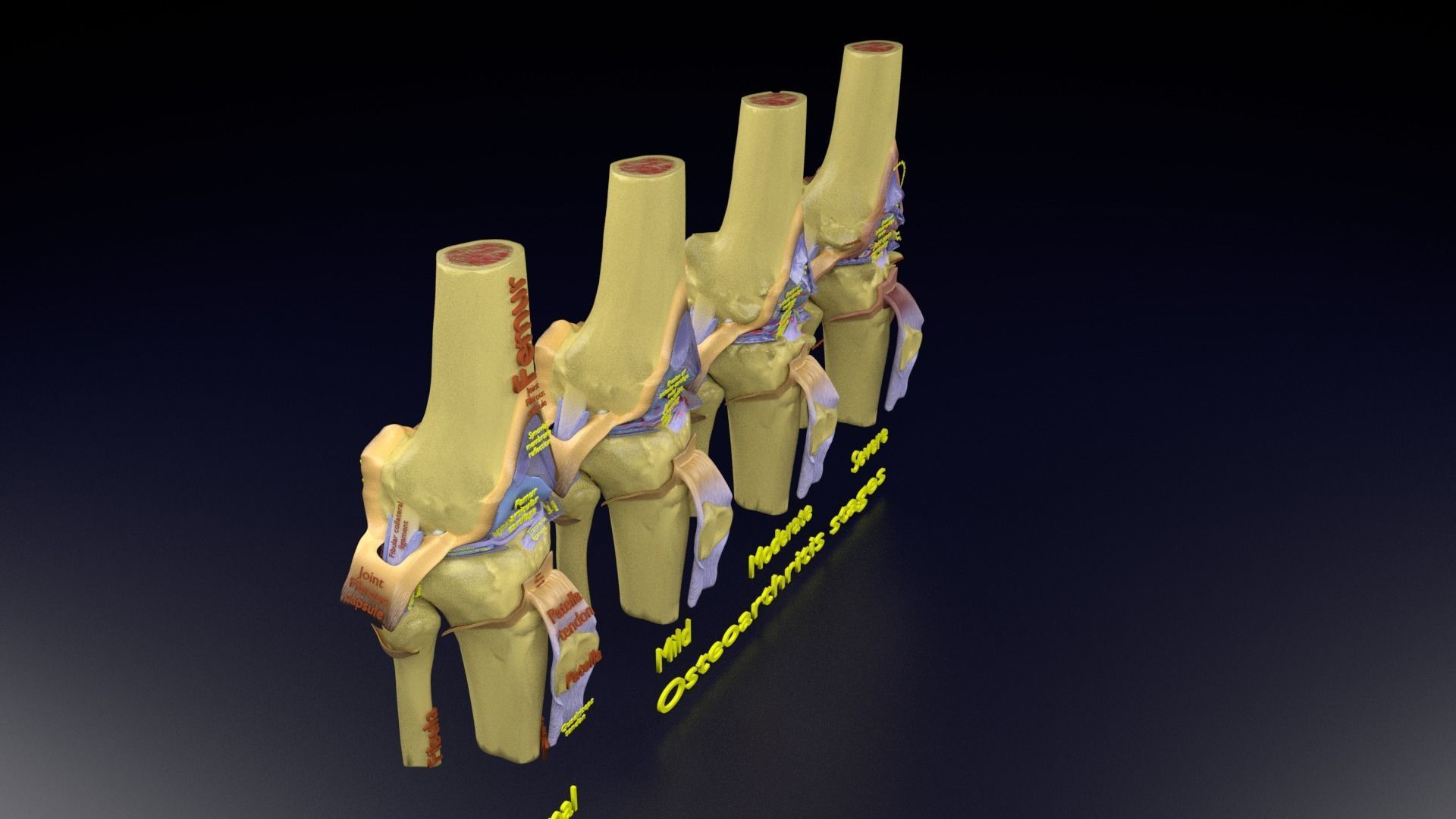 Osteoarthritis stages 3D model_120