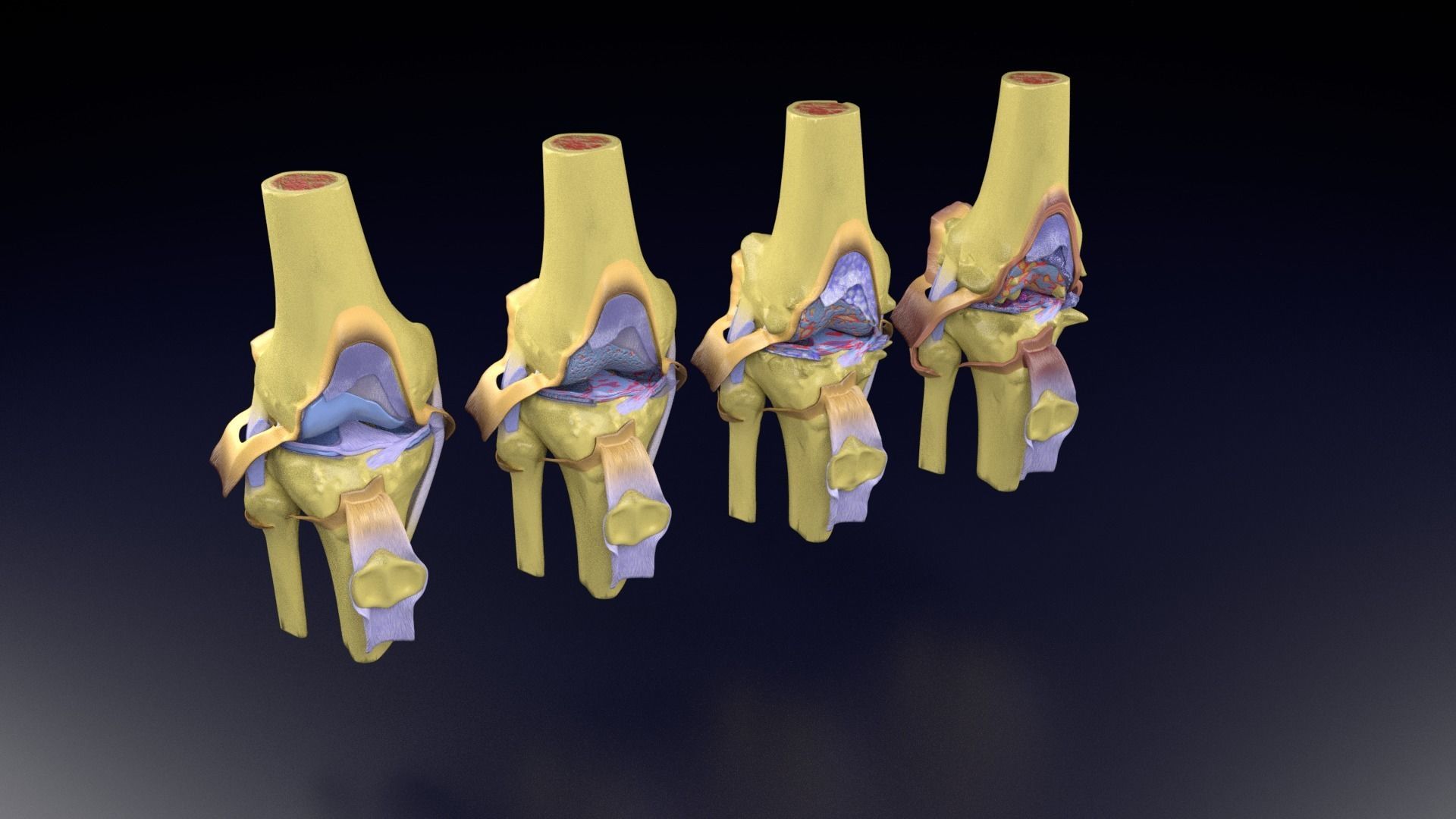 Osteoarthritis stages 3D model_101