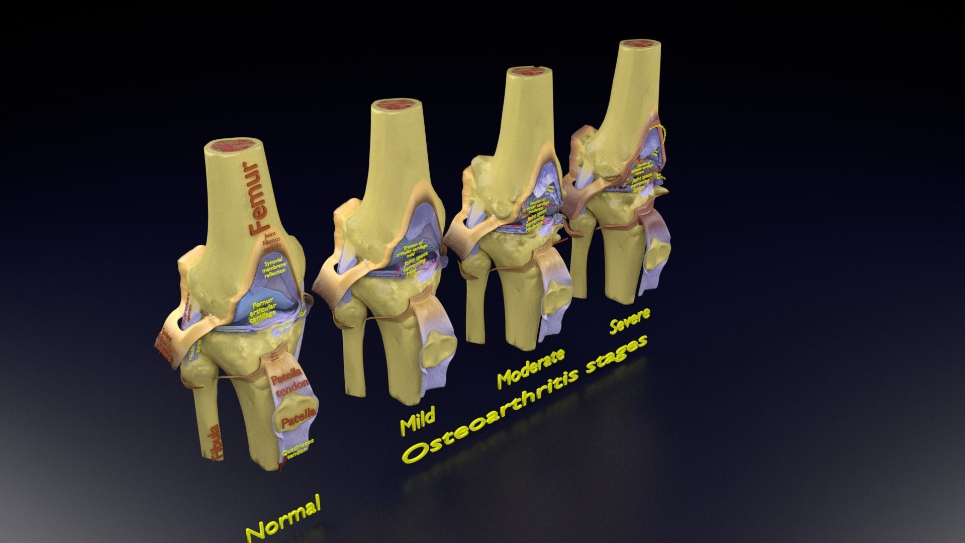 Osteoarthritis stages 3D model_115