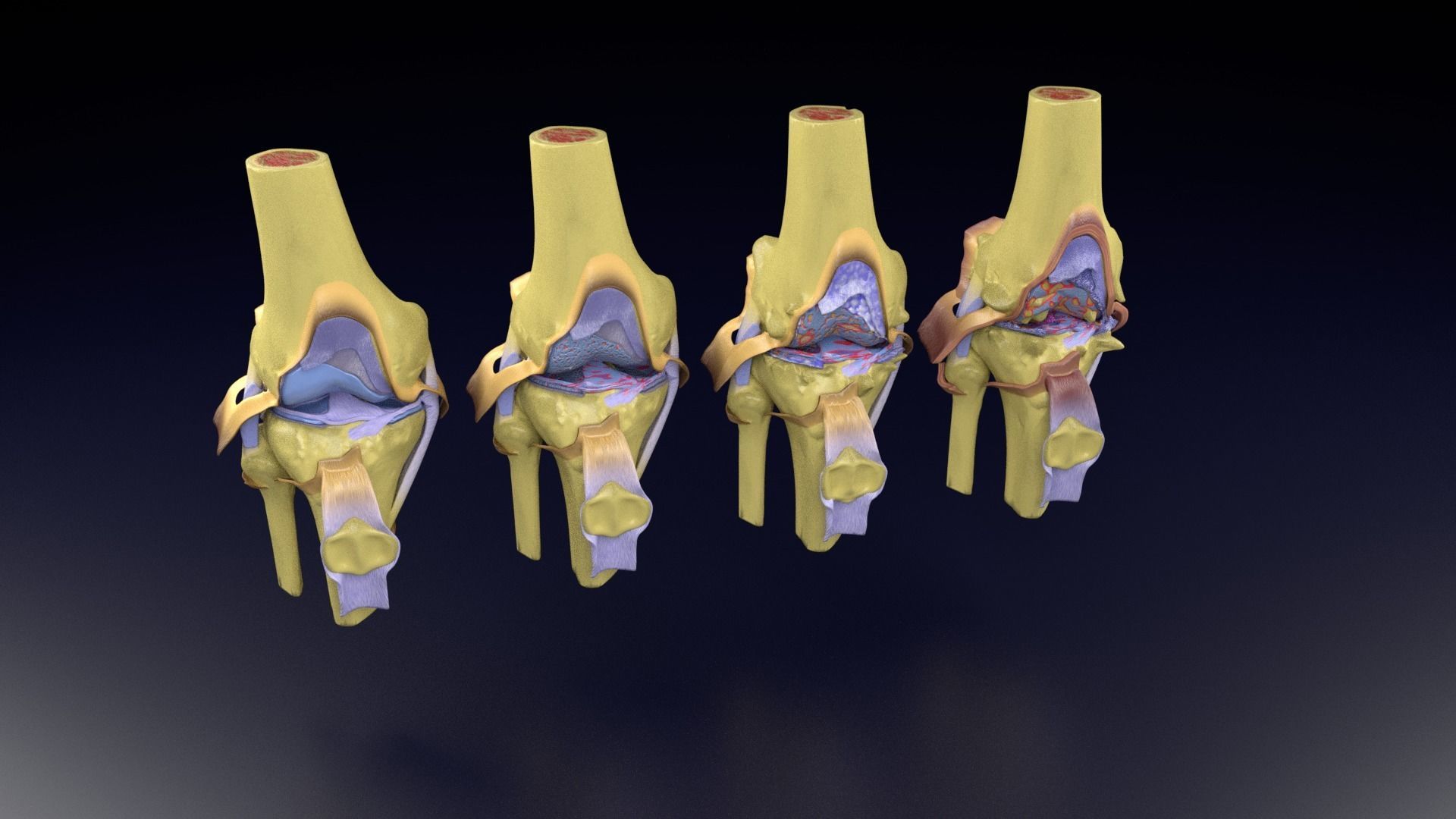 Osteoarthritis stages 3D model_99