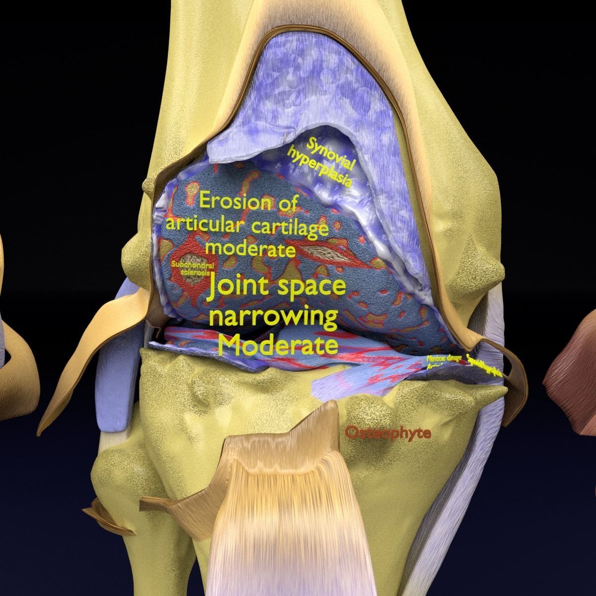 Osteoarthritis stages 3D model_4