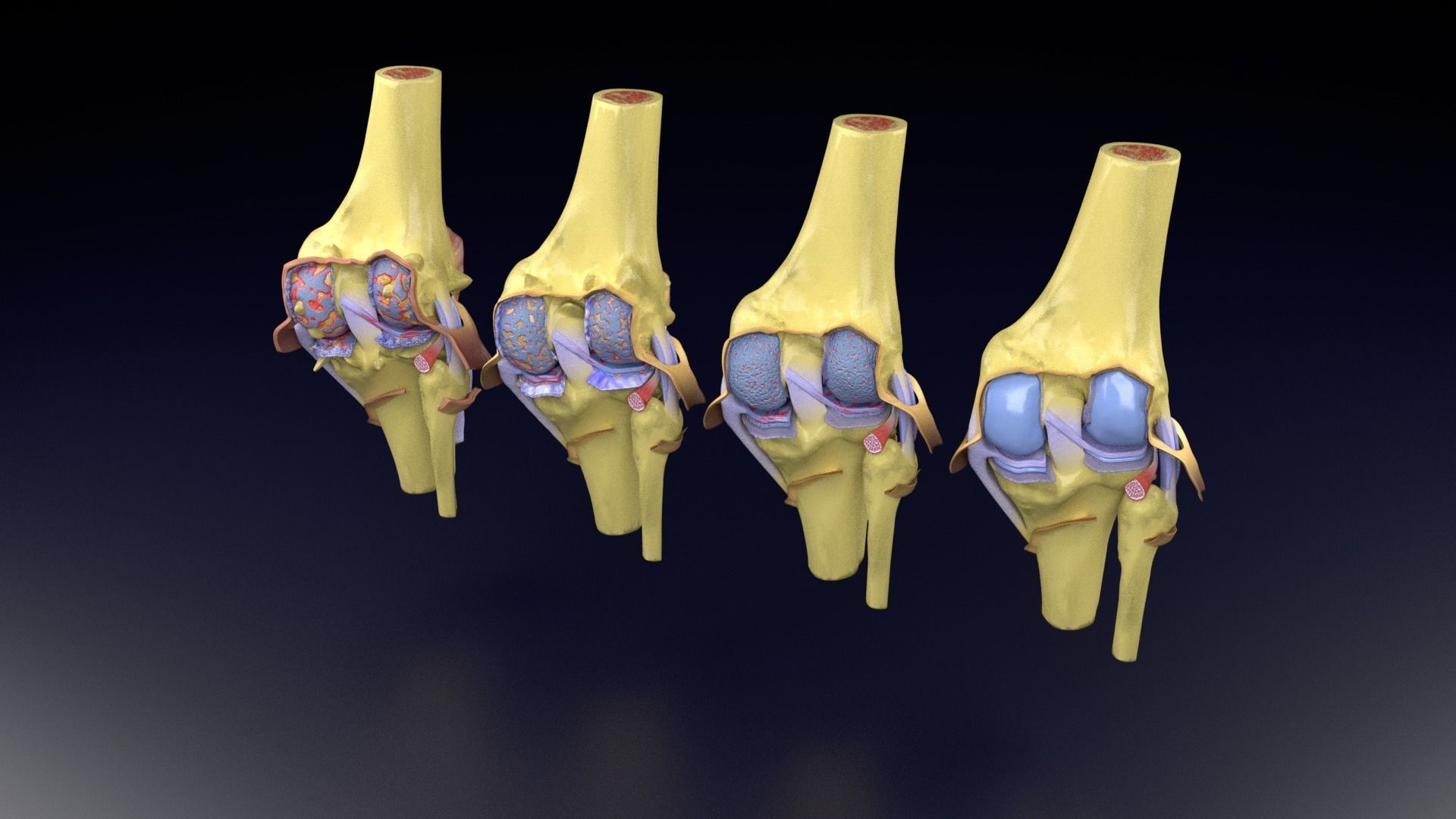 Osteoarthritis stages 3D model_52