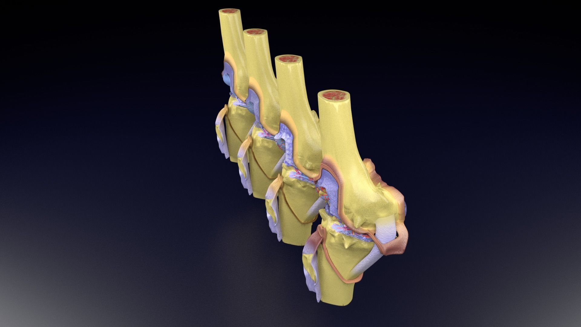 Osteoarthritis stages 3D model_78