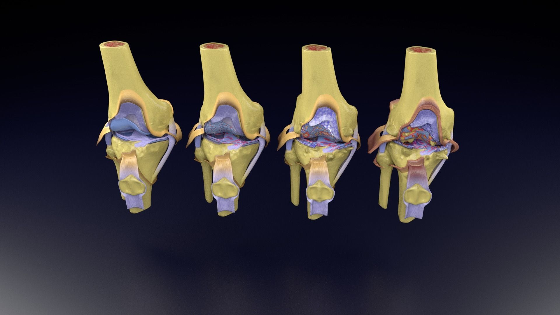 Osteoarthritis stages 3D model_94