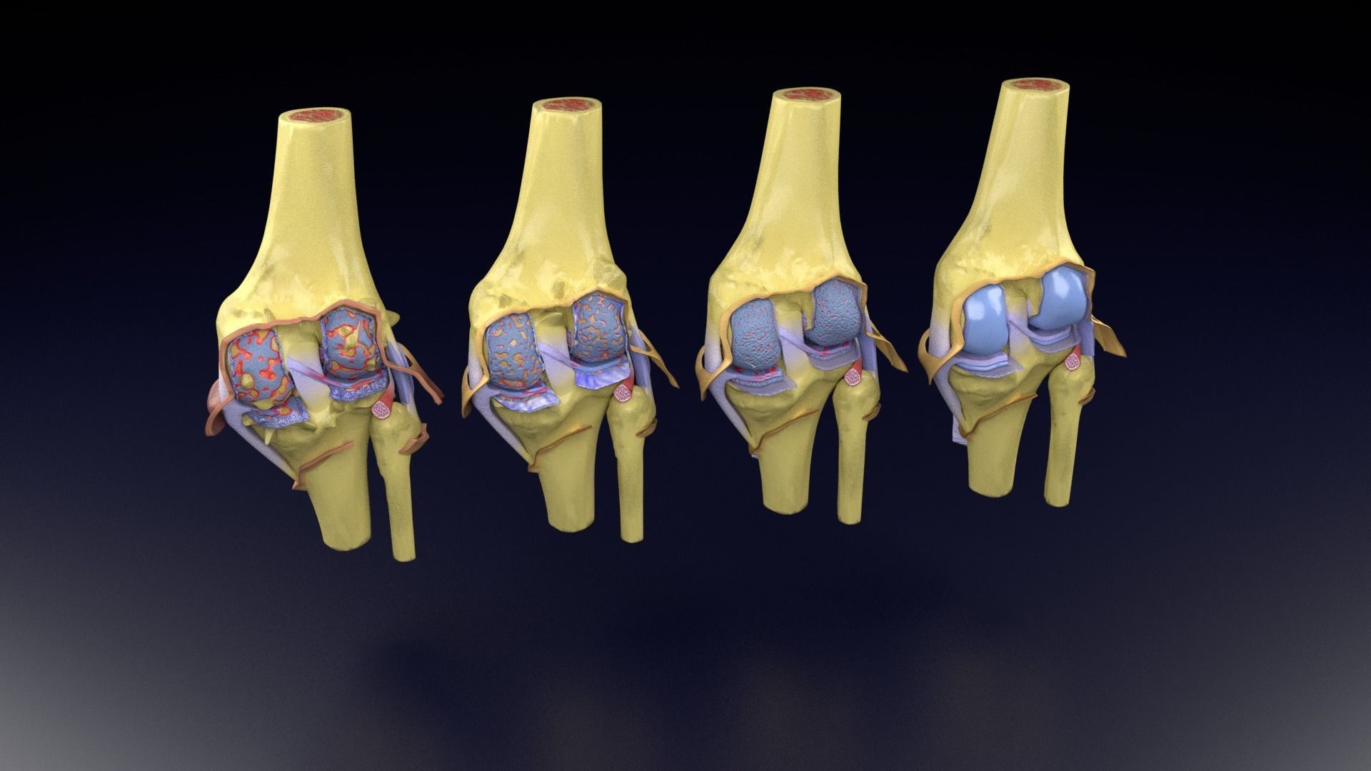 Osteoarthritis stages 3D model_56