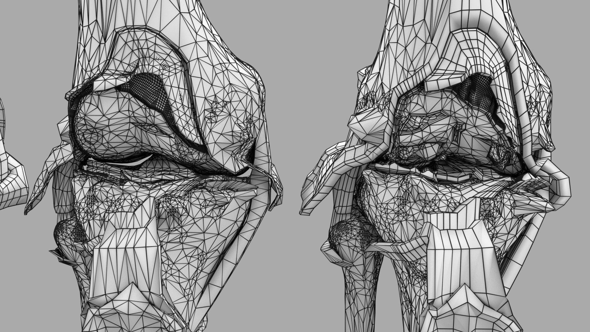 Osteoarthritis stages 3D model_31