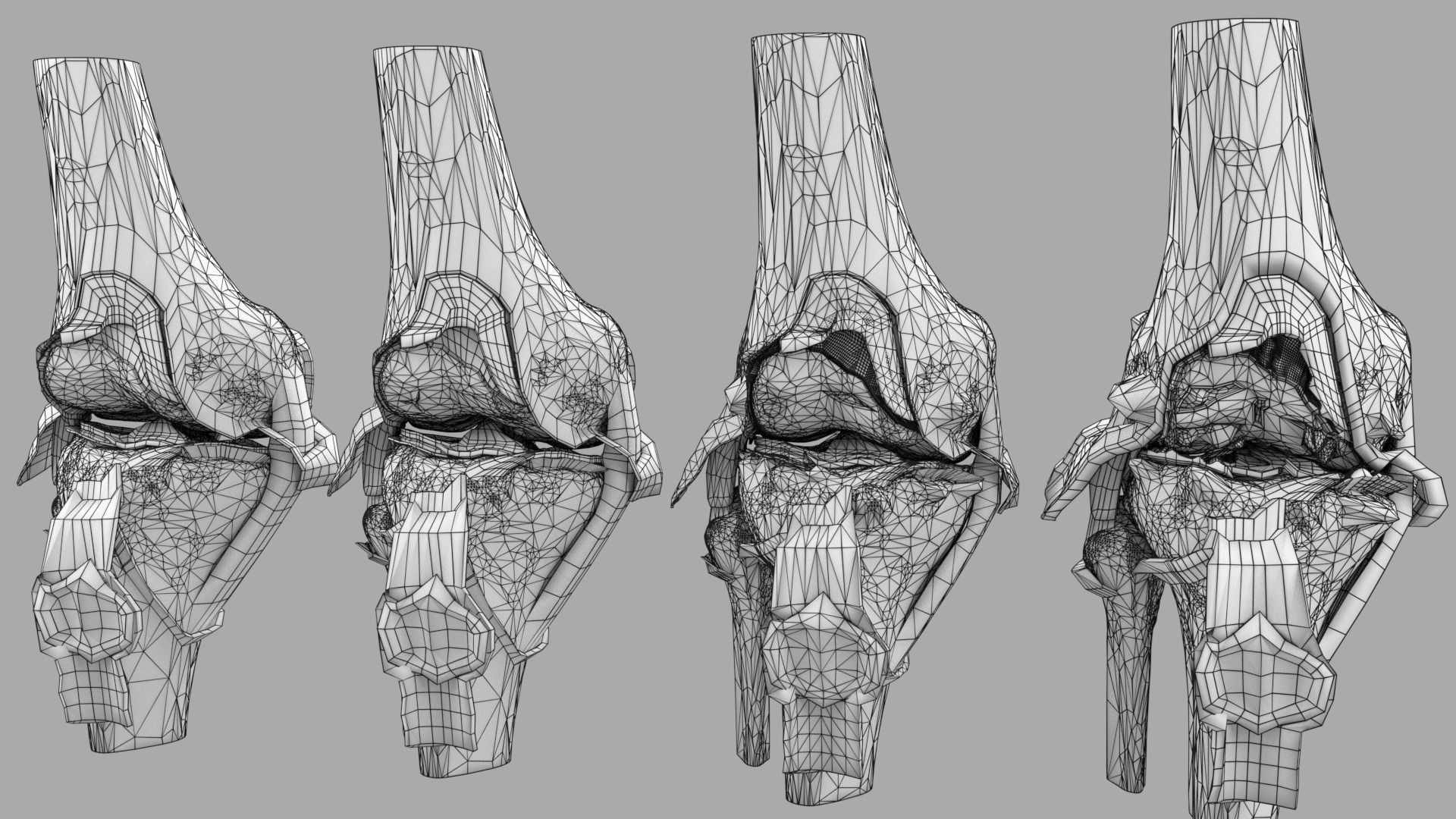 Osteoarthritis stages 3D model_30