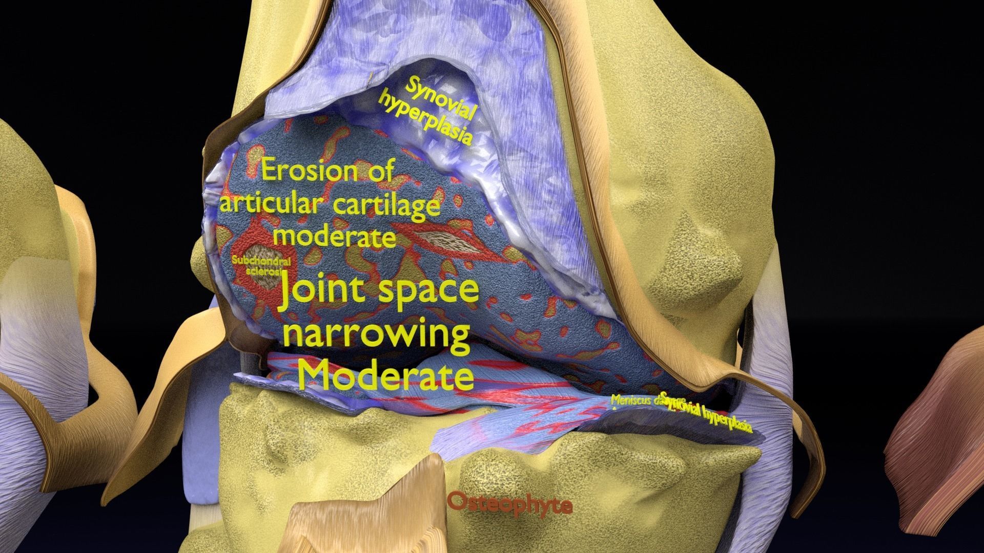 Osteoarthritis stages 3D model_5
