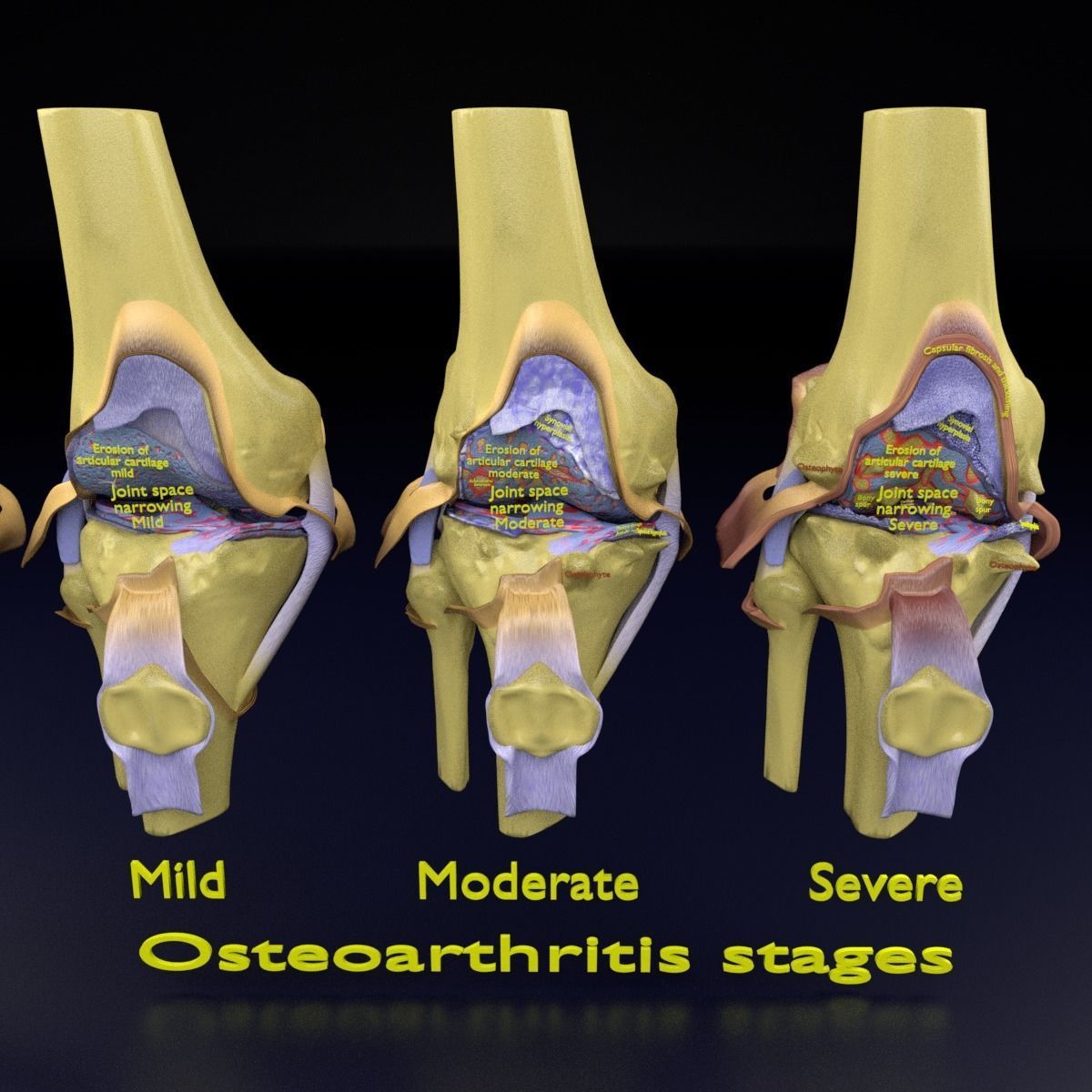 Osteoarthritis stages 3D model_14